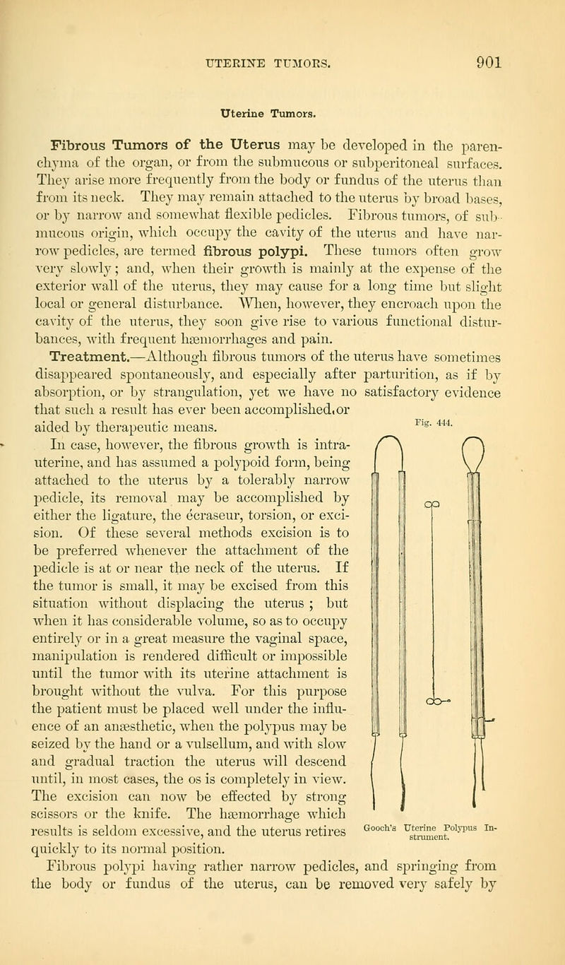 Uterine Tumors. Fig. 444. CO Fibrous Tumors of the Uterus may be developed in the paren- chyma of the organ, or from the submucous or subperitoneal surfaces. They arise more frequently from the body or fundus of the uterus than from its neck. They may remain attached to the uterus by broad bases, or by narrow and somewhat flexible pedicles. Fibrous tumors, of sub mucous origin, which occupy the cavity of the uterus and have nar- row pedicles, are termed fibrous polypi. These tumors often grow very slowly; and, when their growth is mainly at the expense of the exterior wall of the uterus, they may cause for a long time but slight local or general disturbance. When, however, they encroach upon the cavity of the uterus, they soon give rise to various functional distur- bances, with frequent haemorrhages and pain. Treatment.—Although fibrous tumors of the uterus have sometimes disappeared spontaneously, and especially after parturition, as if by absorption, or by strangulation, yet we have no satisfactory evidence that such a result has ever been accomplished, or aided by therapeutic means. In case, however, the fibrous growth is intra- uterine, and has assumed a polypoid form, being attached to the uterus by a tolerably narrow pedicle, its removal may be accomplished by either the ligature, the ecraseur, torsion, or exci- sion. Of these several methods excision is to be preferred whenever the attachment of the pedicle is at or near the neck of the uterus. If the tumor is small, it may be excised from this situation without displacing the uterus ; but when it has considerable volume, so as to occupy entirely or in a great measure the vaginal space, manipulation is rendered difficult or impossible until the tumor with its uterine attachment is brought without the vulva. For this purpose the patient must be placed well under the influ- ence of an anaesthetic, when the polypus may be seized by the hand or a vulsellum, and with slow and gradual traction the uterus will descend until, in most cases, the os is completely in view. The excision can now be effected by strong scissors or the knife. The haemorrhage which results is seldom excessive, and the uterus retires quickly to its normal position. Fibrous polypi having rather narrow pedicles, and springing from the body or fundus of the uterus, can be removed very safely by cb- Gooch's Uterine Polypus In- strument.