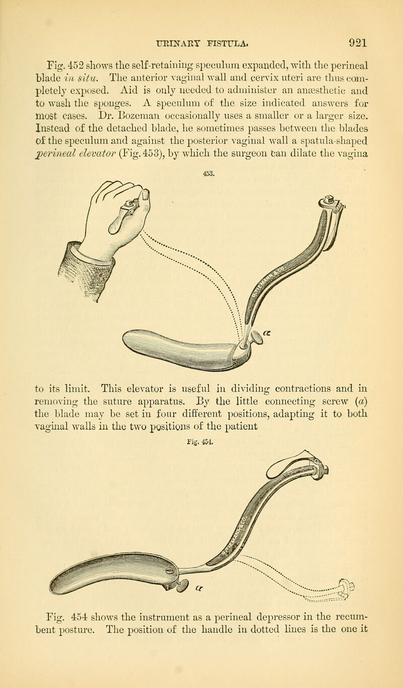 Fig. 452 shows the self-retaining speculum expanded, with the perineal blade in situ. The anterior vaginal wall and cervix uteri are thus com- pletely exposed. Aid is only needed to administer an anaesthetic and to wash the sponges. A speculum of the size indicated answers for most cases. Dr. Bozeman occasionally uses a smaller or a larger size. Instead of the detached blade, he sometimes passes between the blades of the speculum and against the posterior vaginal wall a spatula-shaped perineal elevator (Fig. 453), by which the surgeon Can dilate the vagina to its limit. This elevator is useful in dividing contractions and in removing the suture apparatus. By the little connecting screw (a) the blade may be set in four different positions, adapting it to both vaginal walls in the two positions of the patient Eig. 454. <*?.\. ^:s^r Fig. 454 shows the instrument as a perineal depressor in the recum- bent posture. The position of the handle in dotted lines is the one it