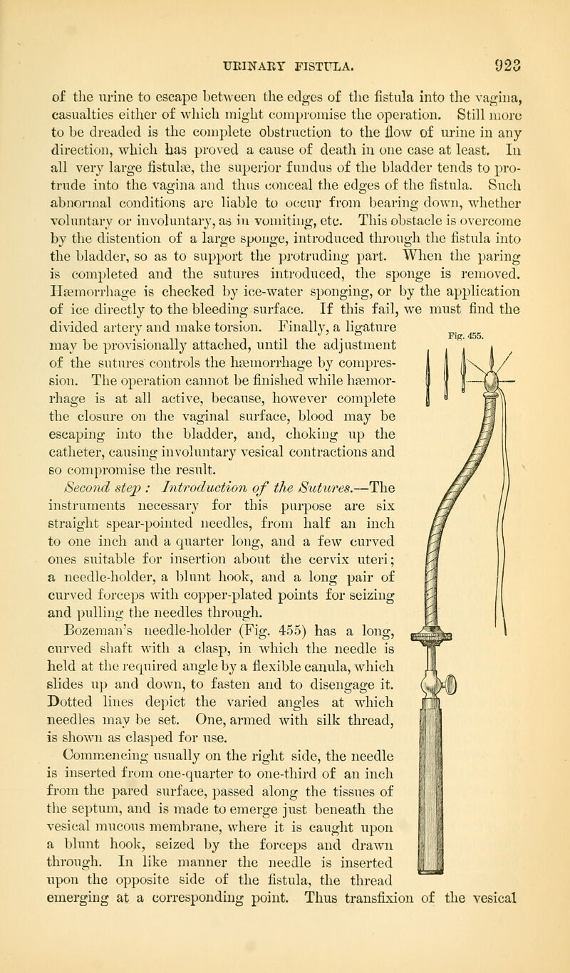 Fig. 455. of the urine to escape between the edges of the fistula into the vagina, casualties either of which might compromise the operation. Still more to be dreaded is the complete obstruction to the flow of urine in any direction, which has proved a cause of death in one case at least. In all very large fistulas, the superior fundus of the bladder tends to pro- trude into the vagina and thus conceal the edges of the fistula. Such abnormal conditions are liable to occur from bearing down, whether voluntary or involuntary, as in vomiting, etc. This obstacle is overcome by the distention of a large sponge, introduced through the fistula into the bladder, so as to support the protruding part. When the paring is completed and the sutures introduced, the sponge is removed. Haemorrhage is checked by ice-water sponging, or by the application of ice directly to the bleeding surface. If this fail, we must find the divided artery and make torsion. Finally, a ligature may be provisionally attached, until the adjustment of the sutures controls the haemorrhage by compres- sion. The operation cannot be finished while haemor- rhage is at all active, because, however complete the closure on the vaginal surface, blood may be escaping into the bladder, and, choking up the catheter, causing involuntary vesical contractions and so compromise the result. Second stej?: Introduction of the Sutures.—The instruments necessary for this purpose are six straight spear-pointed needles, from half an inch to one inch and a quarter long, and a few curved ones suitable for insertion about the cervix uteri; a needle-holder, a blunt hook, and a long pair of curved forceps with copper-plated points for seizing and pulling the needles through. Bozeman's needle-holder (Fig. 455) has a long, curved shaft with a clasp, in which the needle is held at the recpiired angle by a flexible canula, which slides up and down, to fasten and to disengage it. Dotted lines depict the varied angles at which needles may be set. One, armed with silk thread, is shown as clasped for use. Commencing usually on the right side, the needle is inserted from one-quarter to one-third of an inch from the pared surface, passed along the tissues of the septum, and is made to emerge just beneath the vesical mucous membrane, where it is caught upon a blunt hook, seized by the forceps and drawn through. In like manner the needle is inserted upon the opposite side of the fistula, the thread emerging at a corresponding point. Thus transfixion of the vesical