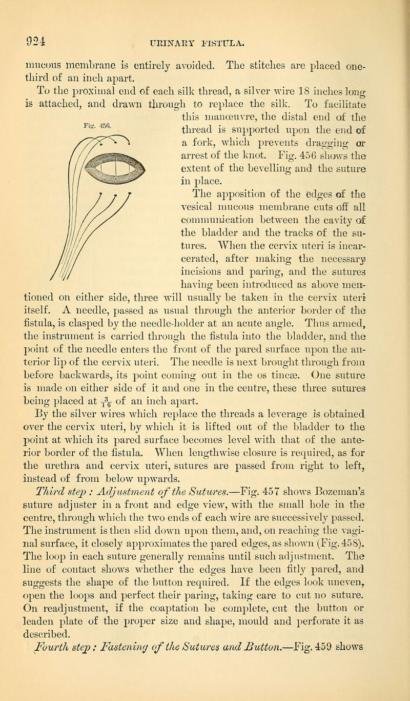 024 Fig. 456. mucous membrane is entirely avoided. The stitches are placed one- third of an inch apart. To the proximal end of each silk thread, a silver wire 18 inches long is attached, and drawn through to replace the silk. To facilitate this manoeuvre, the distal end of the thread is supported upon the end of a fork, which prevents dragging or arrest of the knot. Fig. 456 shows the extent of the bevelling and the suture in place. The apposition of the edges of the vesical mucous membrane cuts off all communication between the cavity of the bladder and the tracks of the su- tures. When the cervix uteri is incar- cerated, after making the necessary incisions and paring, and the sutures having been introduced as above men- tioned on either side, three will usually be taken in the cervix uteri itself. A needle, passed as usual through the anterior border of the fistula, is clasped by the needle-holder at an acute angle. Thus armed, the instrument is carried through the fistula into the bladder, and the point of the needle enters the front of the pared surface upon the an- terior lip of the cervix uteri. The needle is next brought through from before backwards,, its point coming out in the os tincse. One suture is made on either side of it and one in the centre, these three sutures being placed at T3g- of an inch apart. By the silver wires which replace the threads a leverage is obtained over the cervix uteri, by which it is lifted out of the bladder to the point at which its pared surface becomes level with that of the ante- rior border of the fistula. When lengthwise closure is required, as for the urethra and cervix uteri, sutures are passed from right to left, instead of from below upwards. Third step : Adjustment of the Sutures.—Fig. 457 shows Bozeman's suture adjuster in a front and edge view, with the small hole in the centre, through which the two ends of each wire are successively passed. The instrument is then slid down upon them, and, on reaching the vagi- nal surface, it closely approximates the pared edges, as shown (Fig. 458). The loop in each suture generally remains until such adj ustment. The line of contact shows whether the edges have been fitly pared, and suggests the shape of the button required. If the edges look uneven, open the loops and perfect their paring, taking care to cut no suture. On readjustment, if the coaptation be complete, cut the button or leaden plate of the proper size and shape, mould and perforate it as described. Fourth step: Fastening of the Sutures and Button.—Fig. 459 shows