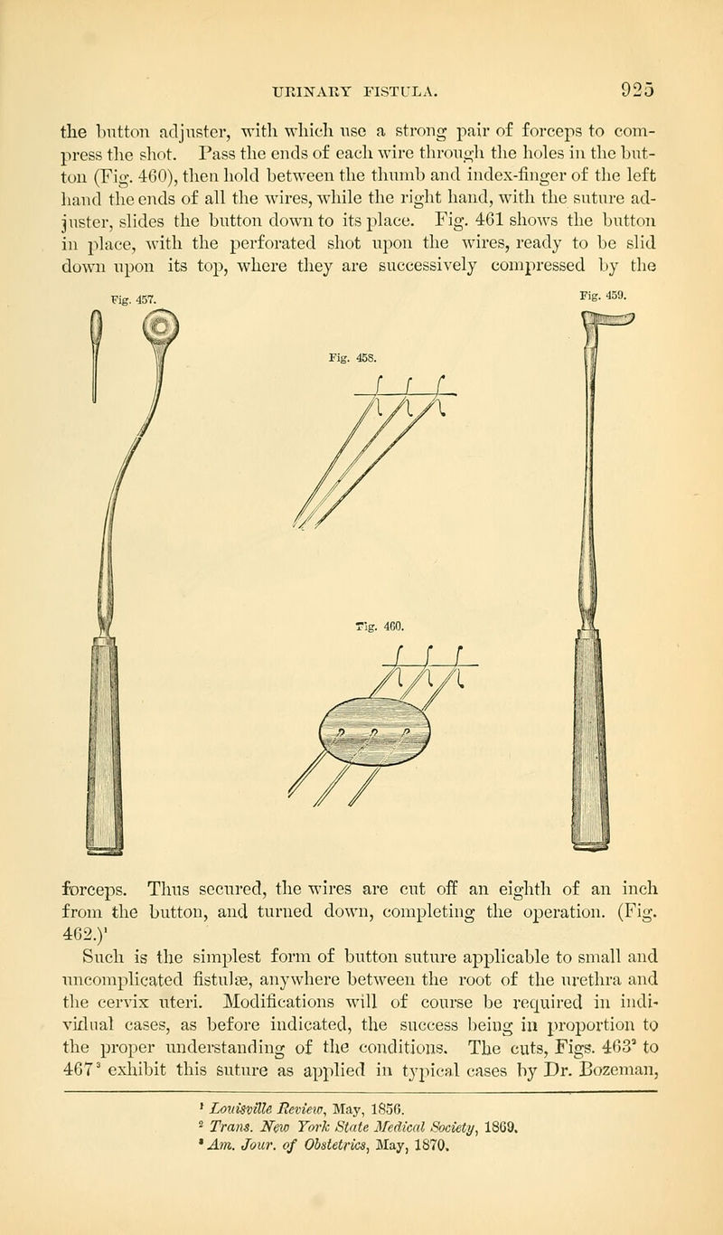 the button adjuster, with which use a strong pair of forceps to com- press the shot. Pass the ends of each wire through the holes in the hut- ton (Fig. 460), then hold between the thumb and index-finger of the left hand the ends of all the wires, while the right hand, with the suture ad- juster, slides the button down to its place. Fig. 461 shows the button in place, with the perforated shot upon the wires, ready to be slid down upon its top, where they are successively compressed by the Fig. 457. Fig. 459. Fig. 45S. Tig. 460. forceps. Thus secured, the wires are cut off an eighth of an inch from the button, and turned down, completing the operation. (Fig. 462.)1 Such is the simplest form of button suture applicable to small and uncomplicated fistulse, anywhere between the root of the urethra and the cervix uteri. Modifications will of course be required in indi- vidual cases, as before indicated, the success being in proportion to the proper understanding of the conditions. The cuts, Figs. 463a to 4673 exhibit this suture as applied in typical cases by Dr. Bozeman, 1 Louisville Review, May, 1856. 2 Trans. New York State Medical Society, 1869. * Am. Jour, of Obstetrics, May, 1870.