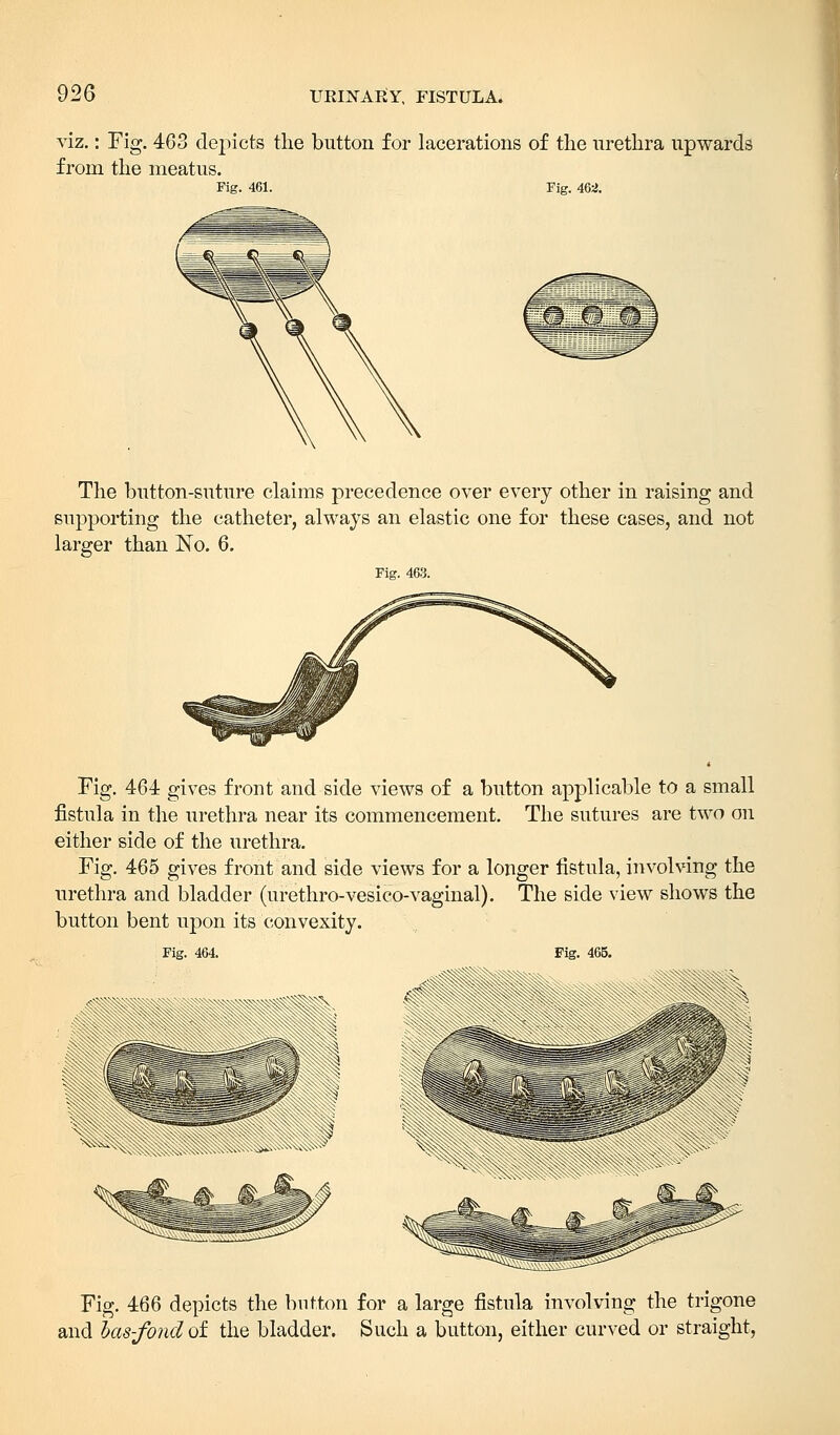 viz.: Fig. 463 depicts the button for lacerations of the urethra upwards from the meatus. Fig. 461. Fig. 462. The button-suture claims precedence over every other in raising and supporting the catheter, always an elastic one for these cases, and not larger than No. 6. Fig. 463. Fig. 464 gives front and side views of a button applicable to a small fistula in the urethra near its commencement. The sutures are two on either side of the urethra. Fig. 465 gives front and side views for a longer fistula, involving the urethra and bladder (urethro-vesico-vaginal). The side view shows the button bent upon its convexity. Fig. 465. Fig. 464. v^NV\ Fig. 466 depicts the button for a large fistula involving the trigone and las-fond of the bladder. Such a button, either curved or straight,