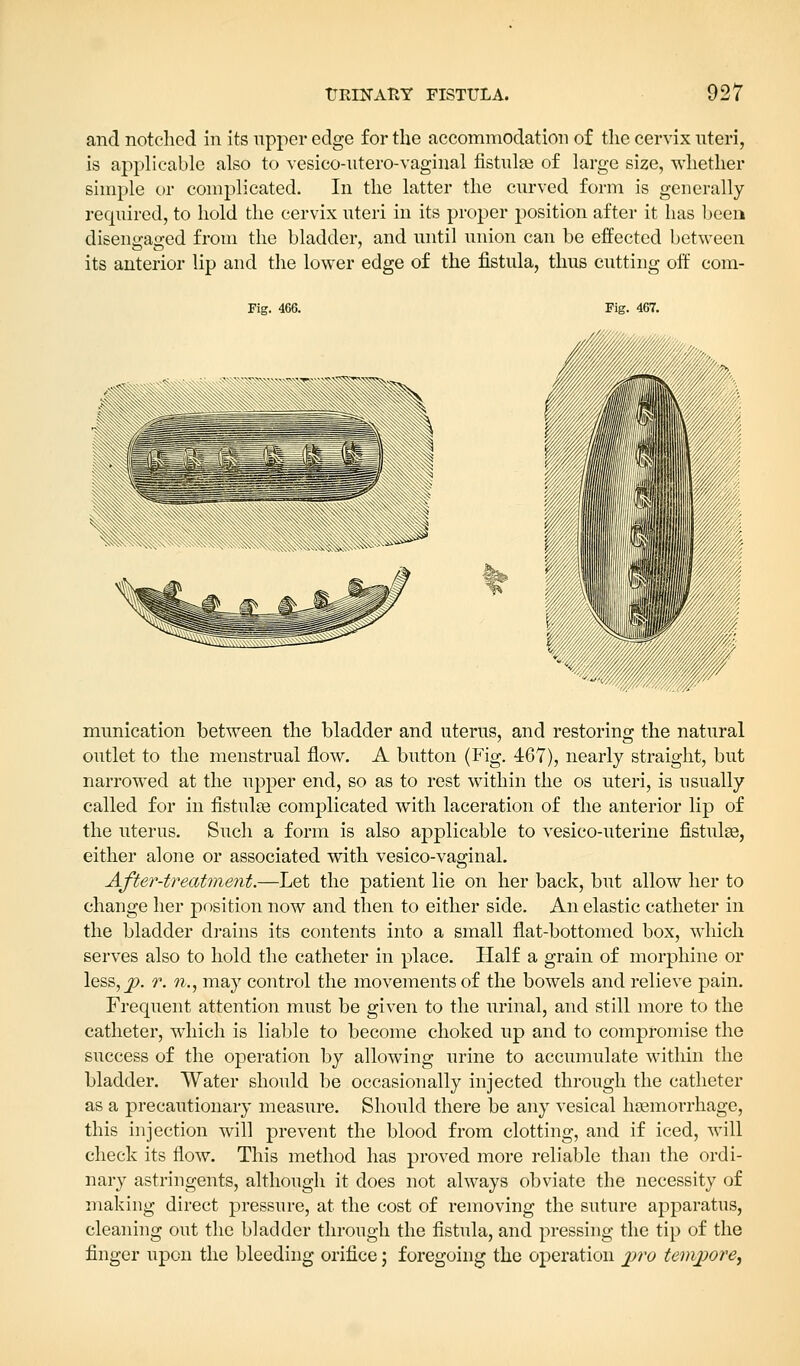 and notched in its upper edge for the accommodation of the cervix uteri, is applicable also to vesico-utero-vaginal fistulas of large size, whether simple or complicated. In the latter the curved form is generally required, to hold the cervix uteri in its proper position after it has been disengaged from the bladder, and until union can be effected between its anterior lip and the lower edge of the fistula, thus cutting off corn- Fig. 466. munication between the bladder and uterus, and restoring the natural outlet to the menstrual flow. A button (Fig. 467), nearly straight, but narrowed at the upper end, so as to rest within the os uteri, is usually called for in fistulae complicated with laceration of the anterior lip of the uterus. Such a form is also applicable to vesico-uterine fistulas, either alone or associated with vesico-vaginal. After-treatment.—Let the patient lie on her back, but allow her to change her position now and then to either side. An elastic catheter in the bladder drains its contents into a small flat-bottomed box, which serves also to hold the catheter in place. Half a grain of morphine or less, p. r. n., may control the movements of the bowels and relieve pain. Frequent attention must be given to the urinal, and still more to the catheter, which is liable to become choked up and to compromise the success of the operation by allowing urine to accumulate within the bladder. Water should be occasionally injected through the catheter as a precautionary measure. Should there be any vesical haemorrhage, this injection will prevent the blood from clotting, and if iced, will check its flow. This method has proved more reliable than the ordi- nary astringents, although it does not always obviate the necessity of making direct pressure, at the cost of removing the suture apparatus, cleaning out the bladder through the fistula, and pressing the tip of the finger upon the bleeding orifice; foregoing the operation pro tempore,