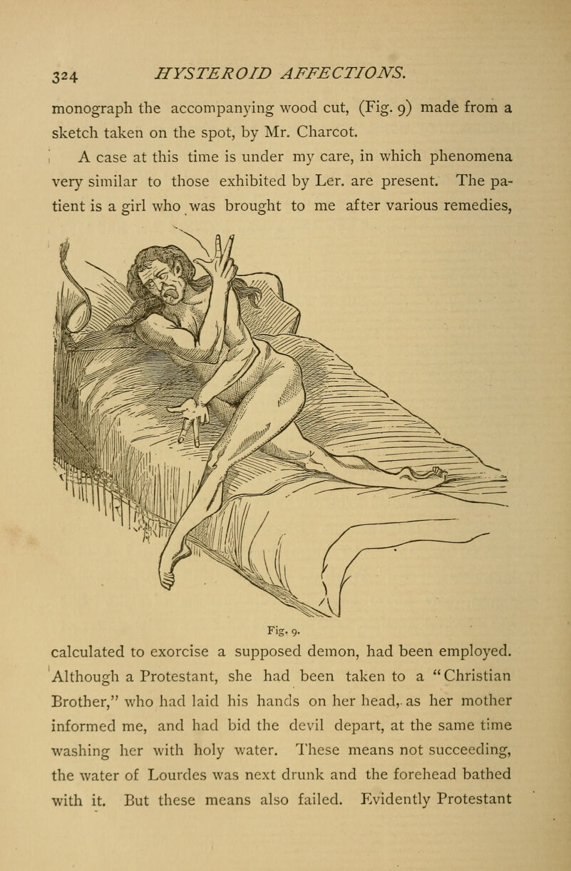 monograph the accompanying wood cut, (Fig. 9) made from a sketch taken on the spot, by Mr. Charcot. A case at this time is under my care, in which phenomena very similar to those exhibited by Ler. are present. The pa- tient is a girl who was brought to me after various remedies, Fig. 9. calculated to exorcise a supposed demon, had been employed. Although a Protestant, she had been taken to a Christian Brother, who had laid his hands on her head,, as her mother informed me, and had bid the devil depart, at the same time washing her with holy water. These means not succeeding, the water of Lourdes was next drunk and the forehead bathed with it. But these means also failed. Evidently Protestant