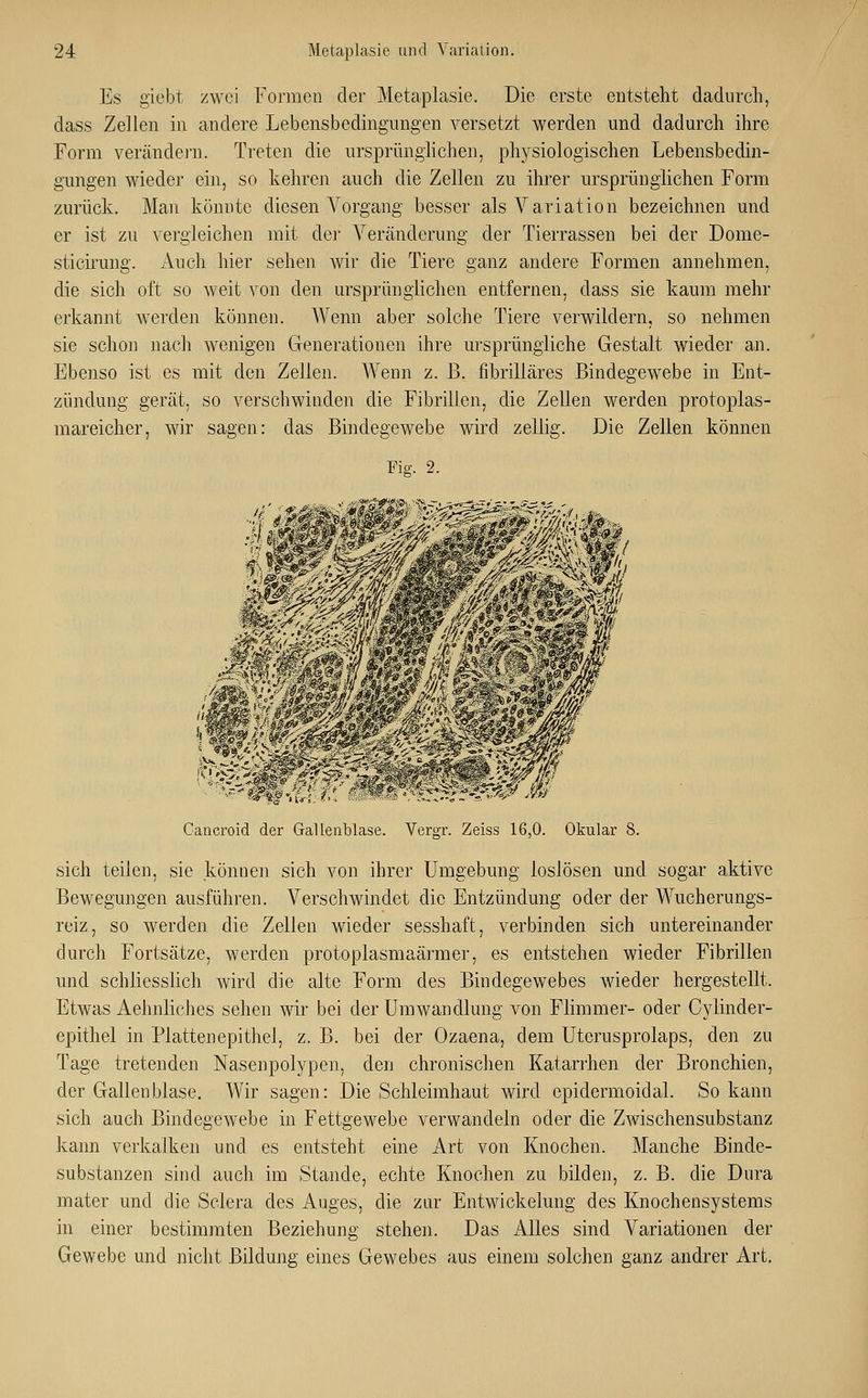 Es giebt zwei Formen der Metaplasie. Die erste entstellt dadurch, dass Zellen in andere Lebensbedingungen versetzt werden und dadurch ihre Form verändern. Treten die ursprünglichen, physiologischen Lebensbedin- gungen wieder ein, so kehren auch die Zellen zu ihrer ursprünglichen Form zurück. Man könnte diesen Vorgang besser als Variation bezeichnen und er ist zu vergleichen mit der Veränderung der Tierrassen bei der Dome- sticirung. Auch hier sehen wir die Tiere ganz andere Formen annehmen, die sich oft so weit von den ursprünglichen entfernen, dass sie kaum mehr erkannt werden können. Wenn aber solche Tiere verwildern, so nehmen sie schon nach wenigen Generationen ihre ursprüngliche Gestalt wieder an. Ebenso ist es mit den Zellen. Wenn z. ß. fibrilläres Bindegewebe in Ent- zündung gerät, so verschwinden die Fibrillen, die Zellen werden protoplas- mareicher, wir sagen: das Bindegewebe wird zellig. Die Zellen können Fig. 2. Cancroid der Gallenblase. Vergr. Zeiss 16,0. Okular 8. sich teilen, sie können sich von ihrer Umgebung loslösen und sogar aktive Bewegungen ausführen. Verschwindet die Entzündung oder der Wucherungs- reiz, so werden die Zellen wieder sesshaft, verbinden sich untereinander durch Fortsätze, werden protoplasmaärmer, es entstehen wieder Fibrillen und schliesslich wird die alte Form des Bindegewebes wieder hergestellt. Etwas Aehnliches sehen wir bei der Umwandlung von Flimmer- oder Cylinder- epithel in Platten epithel, z. B. bei der Ozaena, dem Uterusprolaps, den zu Tage tretenden Nasenpolypen, den chronischen Katarrhen der Bronchien, der Gallenblase. Wir sagen: Die Schleimhaut wird epidermoidal. So kann sich auch Bindegewebe in Fettgewebe verwandeln oder die Zwischensubstanz kann verkalken und es entsteht eine Art von Knochen. Manche Binde- substanzen sind auch im Stande, echte Knochen zu bilden, z. B. die Dura mater und die Sclera des Auges, die zur Entwickelung des Knochensystems in einer bestimmten Beziehung stehen. Das Alles sind Variationen der Gewebe und nicht Bildung eines Gewebes aus einem solchen ganz andrer Art.