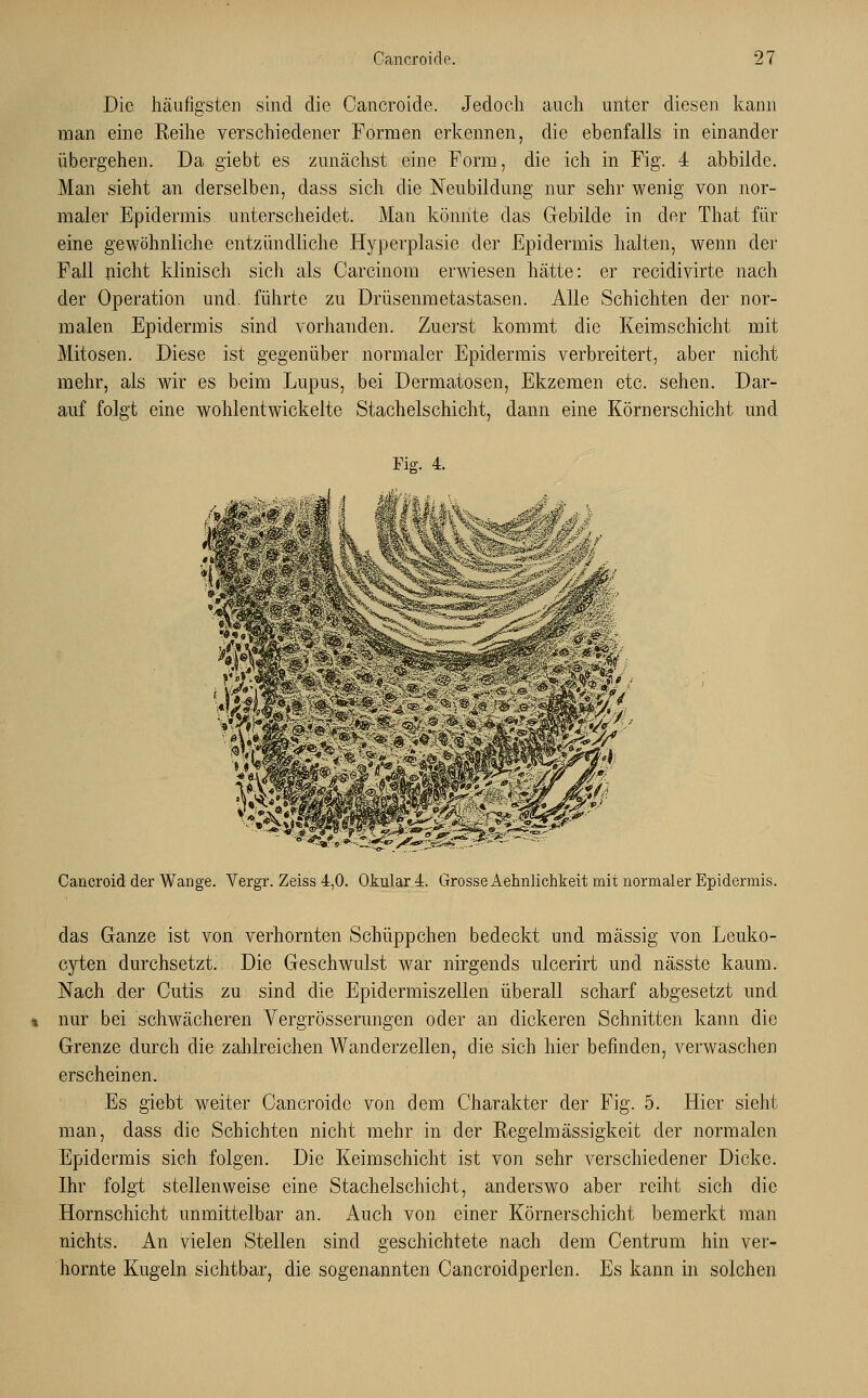 Die häufigsten sind die Cancroide. Jedoch auch unter diesen kann man eine Reihe verschiedener Formen erkennen, die ebenfalls in einander übergehen. Da giebt es zunächst eine Form, die ich in Fig. 4 abbilde. Man sieht an derselben, dass sich die Neubildung nur sehr wenig von nor- maler Epidermis unterscheidet. Man könnte das Gebilde in der That für eine gewöhnliche entzündliche Hyperplasie der Epidermis halten, wenn der Fall nicht klinisch sich als Carcinom erwiesen hätte: er recidivirte nach der Operation und. führte zu Drüsenmetastasen. Alle Schichten der nor- malen Epidermis sind vorhanden. Zuerst kommt die Keimschicht mit Mitosen. Diese ist gegenüber normaler Epidermis verbreitert, aber nicht mehr, als wir es beim Lupus, bei Dermatosen, Ekzemen etc. sehen. Dar- auf folgt eine wohlentwickelte Stachelschicht, dann eine Körnerschicht und Fig. 4. Caucroid der Wange. Vergr. Zeiss 4,0. Okular 4. Grosse Aehnlichkeit mit normaler Epidermis. das Ganze ist von verhornten Schüppchen bedeckt und massig von Leuko- cyten durchsetzt. Die Geschwulst war nirgends ulcerirt und nässte kaum. Nach der Cutis zu sind die Epidermiszellen überall scharf abgesetzt und nur bei schwächeren Vergrösserungen oder an dickeren Schnitten kann die Grenze durch die zahlreichen Wanderzellen, die sich hier befinden, verwaschen erscheinen. Es giebt weiter Cancroide von dem Charakter der Fig. 5. Hier sieht man, dass die Schichten nicht mehr in der Regelmässigkeit der normalen Epidermis sich folgen. Die Keimschicht ist von sehr verschiedener Dicke. Ihr folgt stellenweise eine Stachelschicht, anderswo aber reiht sich die Hornschicht unmittelbar an. Auch von einer Körnerschicht bemerkt man nichts. An vielen Stellen sind geschichtete nach dem Centrum hin ver- hornte Kugeln sichtbar, die sogenannten Cancroidperlen. Es kann in solchen