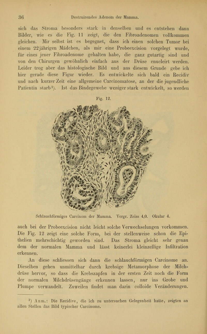 sich das Stroma besonders stark in denselben und es entstehen dann Bilder, wie es die Fig. 11 zeigt, die den Fibroadenomen vollkommen gleichen. Mir selbst ist es begegnet, dass ich einen solchen Tumor bei einem 22jährigen Mädchen, als mir eine Probeexcision vorgelegt wurde, für eines jener Fibroadenome gehalten habe, die ganz gutartig sind und von den Chirurgen gewöhnlich einfach aus der Drüse enucleirt werden. Leider trog aber das histologische Bild und aus diesem Grunde gebe ich hier gerade diese Figur wieder. Es entwickelte sich bald ein Recidiv und nach kurzer Zeit eine allgemeine Carcinomatose, an der die jugendliche Patientin starb1). Ist das Bindegewebe wenigerstark entwickelt, so werden Fig. 12. ■M. ., k (3 / Schlauchförmiges Carcinom der Mamma. Vergr. Zeiss 4,0. Okular 4. auch bei der Probeexcision nicht leicht solche Verwechselungen vorkommen. Die Fig. 12 zeigt eine solche Form, bei der stellenweise schon die Epi- thelien mehrschichtig geworden sind. Das Stroma gleicht sehr genau dem der normalen Mamma und lässt keinerlei kleinzellige Infiltration erkennen. An diese schliessen sich dann die schlauchförmigen Carcinome an. Dieselben gehen unmittelbar durch krebsige Metamorphose der Milch- drüse hervor, so dass die Krebszapfen in der ersten Zeit noch die Form der normalen Milchdrüsengänge erkennen lassen, nur ins Grobe und Plumpe verwandelt. Zuweilen findet man darin colioicle Veränderungen. i) Anm.: Die Recidive, die ich zu untersuchen Gelegenheit hatte, zeigten an allen Stellen das Bild typischer Carcinome.