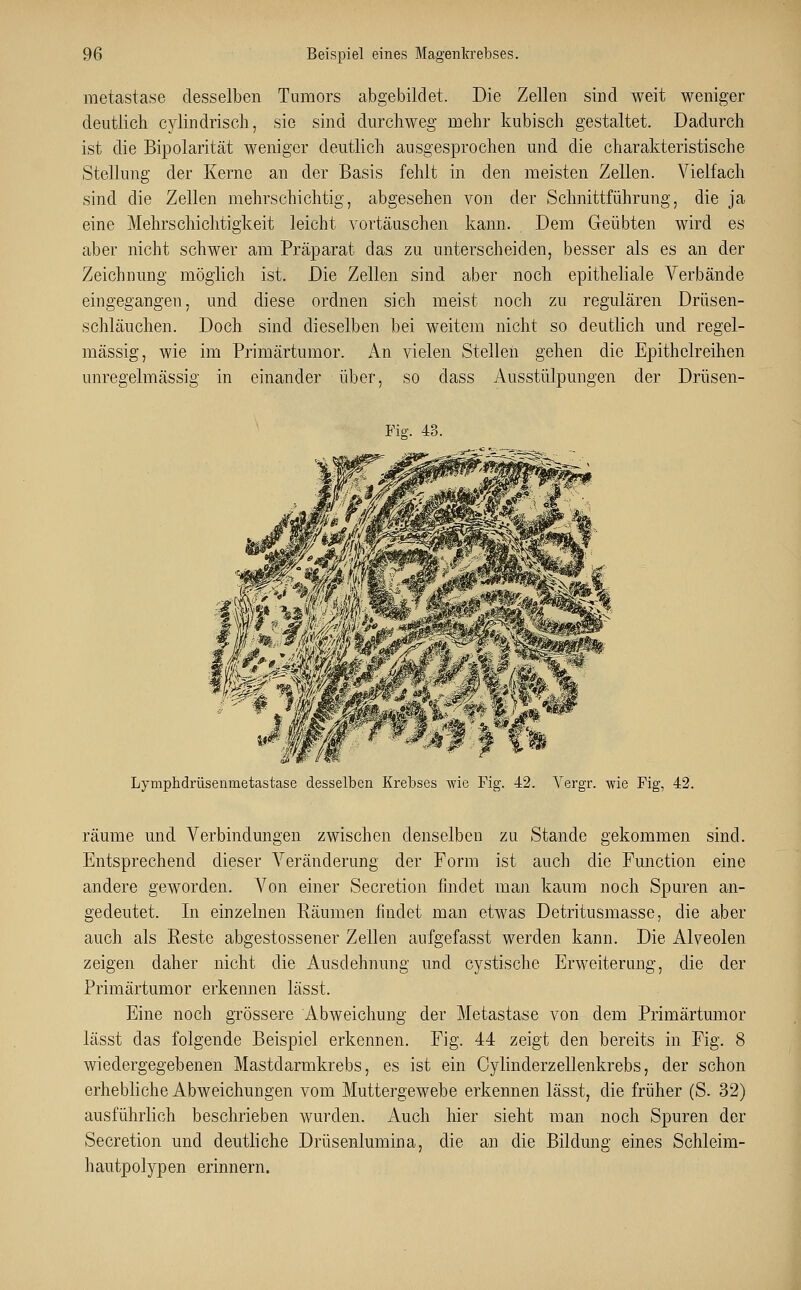 metastase desselben Tumors abgebildet. Die Zellen sind weit weniger deutlich cylindrisch, sie sind durchweg mehr kubisch gestaltet. Dadurch ist die Bipolarität weniger deutlich ausgesprochen und die charakteristische Stellung der Kerne an der Basis fehlt in den meisten Zellen. Vielfach sind die Zellen mehrschichtig, abgesehen von der Schnittführung, die ja eine Mehrschichtigkeit leicht vortäuschen kann. Dem Geübten wird es aber nicht schwer am Präparat das zu unterscheiden, besser als es an der Zeichnung möglich ist. Die Zellen sind aber noch epitheliale Verbände eingegangen, und diese ordnen sich meist noch zu regulären Drüsen- schläuchen. Doch sind dieselben bei weitem nicht so deutlich und regel- mässig, wie im Primärtumor. An vielen Stellen gehen die Epithelreihen unregelmässig in einander über, so dass Ausstülpungen der Drüsen- Fig. 43. Lymphdrüsenmetastase desselben Krebses -wie Fig. 42. Vergr. -wie Fig, 42. räume und Verbindungen zwischen denselben zu Stande gekommen sind. Entsprechend dieser Veränderung der Form ist auch die Function eine andere geworden. Von einer Secretion findet man kaum noch Spuren an- gedeutet. In einzelnen Räumen findet man etwas Detritusmasse, die aber auch als Reste abgestossener Zellen aufgefasst werden kann. Die Alveolen zeigen daher nicht die Ausdehnung und cystische Erweiterung, die der Primärtumor erkennen lässt. Eine noch grössere Abweichung der Metastase von dem Primärtumor lässt das folgende Beispiel erkennen. Fig. 44 zeigt den bereits in Fig. 8 wiedergegebenen Mastdarmkrebs, es ist ein Cylinderzellenkrebs, der schon erhebliche Abweichungen vom Muttergewebe erkennen lässt, die früher (S. 32) ausführlich beschrieben wurden. Auch hier sieht man noch Spuren der Secretion und deutliche Drüsenlumina, die an die Bildung eines Schleim- hautpolypen erinnern.