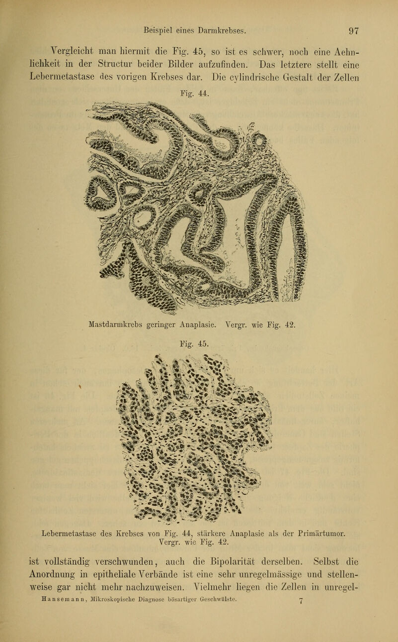 Vergleicht man hiermit die Fig. 45, so ist es schwer, noch eine Aehn- lichkeit in der Structur beider Bilder aufzufinden. Das letztere stellt eine Lebermetastase des vorigen Krebses dar. Die cvlindrische Gestalt der Zellen Fig. 44. Mastdarmkrebs geringer Anaplasie. Vergr. wie Fig. 42. Fig. 45. Lebermetastase des Krebses von Fig. 44, stärkere Anaplasie als der Primärtumor. Vergr. wie Fig. 42. ist vollständig verschwunden, auch die Bipolarität derselben. Selbst die Anordnung in epitheliale Verbände ist eine sehr unregelmässige und stellen- weise gar nicht mehr nachzuweisen. Vielmehr liegen die Zellen in unregel- Hansemann, Mikroskopische Diagnose bösartiger Geschwülste. n