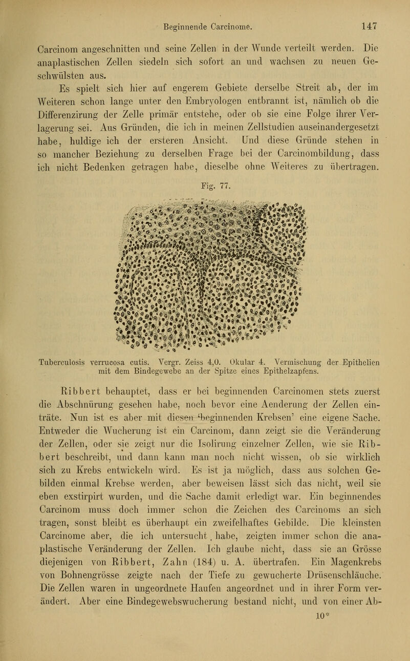Carcinom angeschnitten und seine Zellen in der Wunde verteilt werden. Die anaplastischen Zellen siedeln sich sofort an und wachsen zu neuen Ge- schwülsten aus. Es spielt sich hier auf engerem Gebiete derselbe Streit ab, der im Weiteren schon lange unter den Embryologen entbrannt ist, nämlich ob die Differenzirung der Zelle primär entstehe, oder ob sie eine Folge ihrer Ver- lagerung sei. Aus Gründen, die ich in meinen Zellstudien auseinandergesetzt habe, huldige ich der ersteren Ansicht. Und diese Gründe stehen in so mancher Beziehung zu derselben Frage bei der Oarcinombildung, dass ich nicht Bedenken getragen habe, dieselbe ohne Weiteres zu übertragen. Ke. 77. Tuberculosis verrucosa cutis. Vergr. Zeiss 4,0. Okular 4. Vermischung der Epithelien mit dem Bindegewebe an der Spitze eines Epithelzapfens. Ribbert behauptet, dass er bei beginnenden Carcinomen stets zuerst die Abschnürung gesehen habe, noch bevor eine Aenderimg der Zellen ein- träte. Nun ist es aber mit diesen 'beginnenden Krebsen' eine eigene Sache. Entweder die Wucherung ist ein Carcinom, dann zeigt sie die Veränderung der Zellen, oder sie zeigt nur die Isolirung einzelner Zellen, wie sie Rib- bert beschreibt, und dann kann man noch nicht wissen, ob sie wirklich sich zu Krebs entwickeln wird. Es ist ja möglich, dass aus solchen Ge- bilden einmal Krebse werden, aber beweisen lässt sich das nicht, weil sie eben exstirpirt wurden, und die Sache damit erledigt war. Ein beginnendes Carcinom muss doch immer schon die Zeichen des Carcinoms an sich tragen, sonst bleibt es überhaupt ein zweifelhaftes Gebilde. Die kleinsten Carcinome aber, die ich untersucht. habe, zeigten immer schon die ana- plastische Veränderung der Zellen. Ich glaube nicht, dass sie an Grösse diejenigen von Ribbert, Zahn (184) u. A. übertrafen. Ein Magenkrebs von Bohnengrösse zeigte nach der Tiefe zu gewucherte Drüsenschläuche. Die Zellen waren in ungeordnete Haufen angeordnet und in ihrer Form ver- ändert. Aber eine Bindegewebswucherung bestand nicht, und von einer Ab- 10*