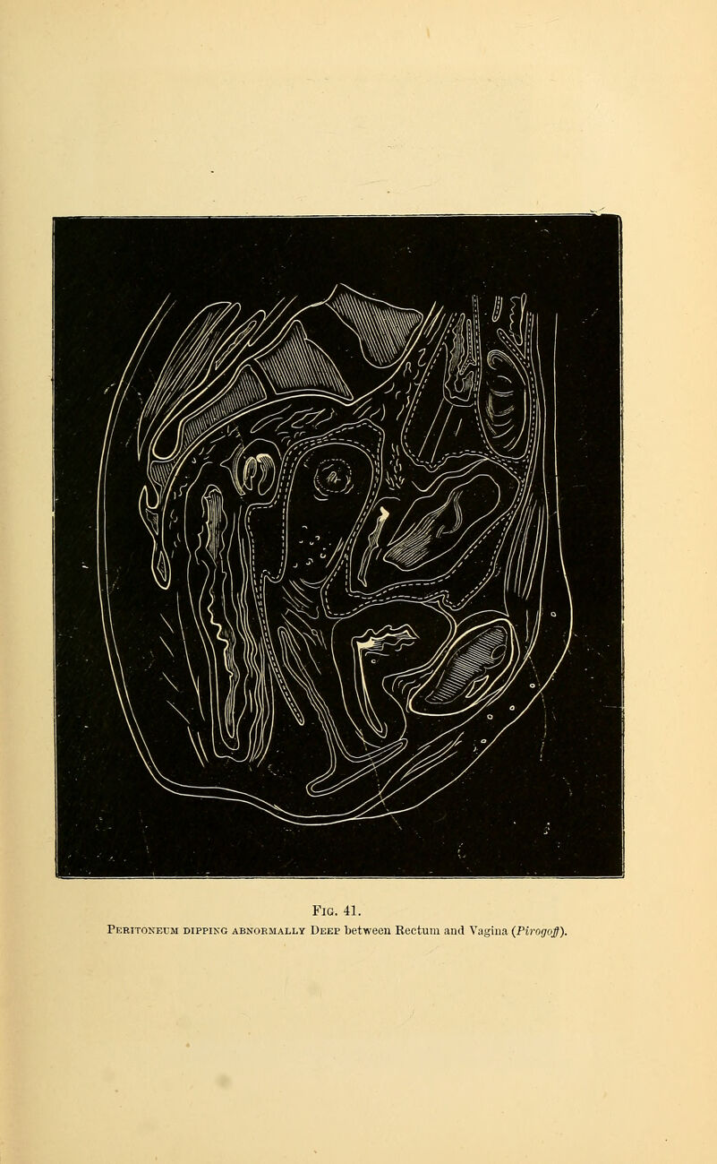 Fig. 41. Peritoneum dipping abnormally Deep between Rectum and Vagina (JPirogojf).