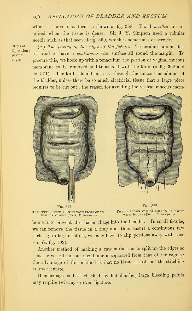 Steps of Operation: paring edses. which a convenient form is shown at fig. 368. Fixed needles are re- quired when the tissue is dense. Sir J. Y. Simpson used a tubular needle such as that seen at fig. 369, which is sometimes of service. (a.) The paring of the edges of the fistula. To produce union, it is essential to have a continuous raw surface all round the margin. To procure this, we hook up with a tenaculum the portion of vaginal mucous membrane to be removed and transfix it with the knife (v. fig. 362 and fig. 371). The knife should not pass through the mucous membrane of the bladder, unless there be so much cicatricial tissue that a large piece requires to be cut out; the reason for avoiding the vesical mucous mem- Fig. 371. Transfixing with a Knife both edges of the Fistula at once (Sir J. Y. Simpson). Fig. 372. Fistula shown at Figs. 370 and 371 closed with Sutures (Sir J. Y. Simpson). brane is to prevent after-haemorrhage into the bladder. In small fistulas, we can remove the tissue in a ring and thus ensure a continuous raw surface; in larger fistulas, we may have to clip portions away with scis- sors (v. fig. 109). Another method of making a raw surface is to split up the edges so that the vesical mucous membrane is separated from that of the vagina; the advantage of this method is that no tissue is lost, but the stitching is less accurate. Haemorrhage is best checked by hot douche; large bleeding points may require twisting or even ligature.