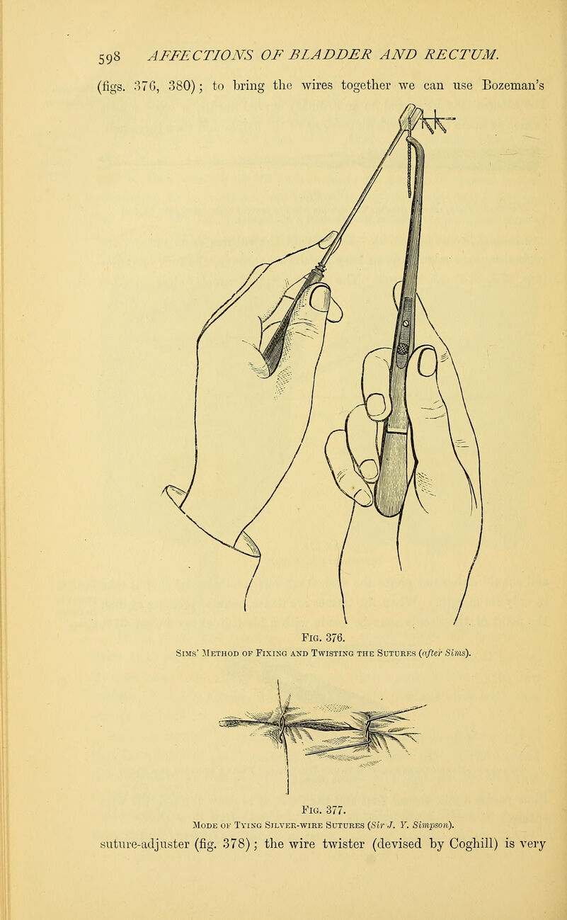 (figs. 37G, 380); to bring the wires together we can use Bozeman's Fig. 376. Sims' Method of Fixing and Twisting the Sutures {after Sims). Fig. 377. Mode ok Tying Silver-wire Sutures (Sir J. Y. Simpson). suture-adjuster (fig. 378); the wire twister (devised by Coghill) is very