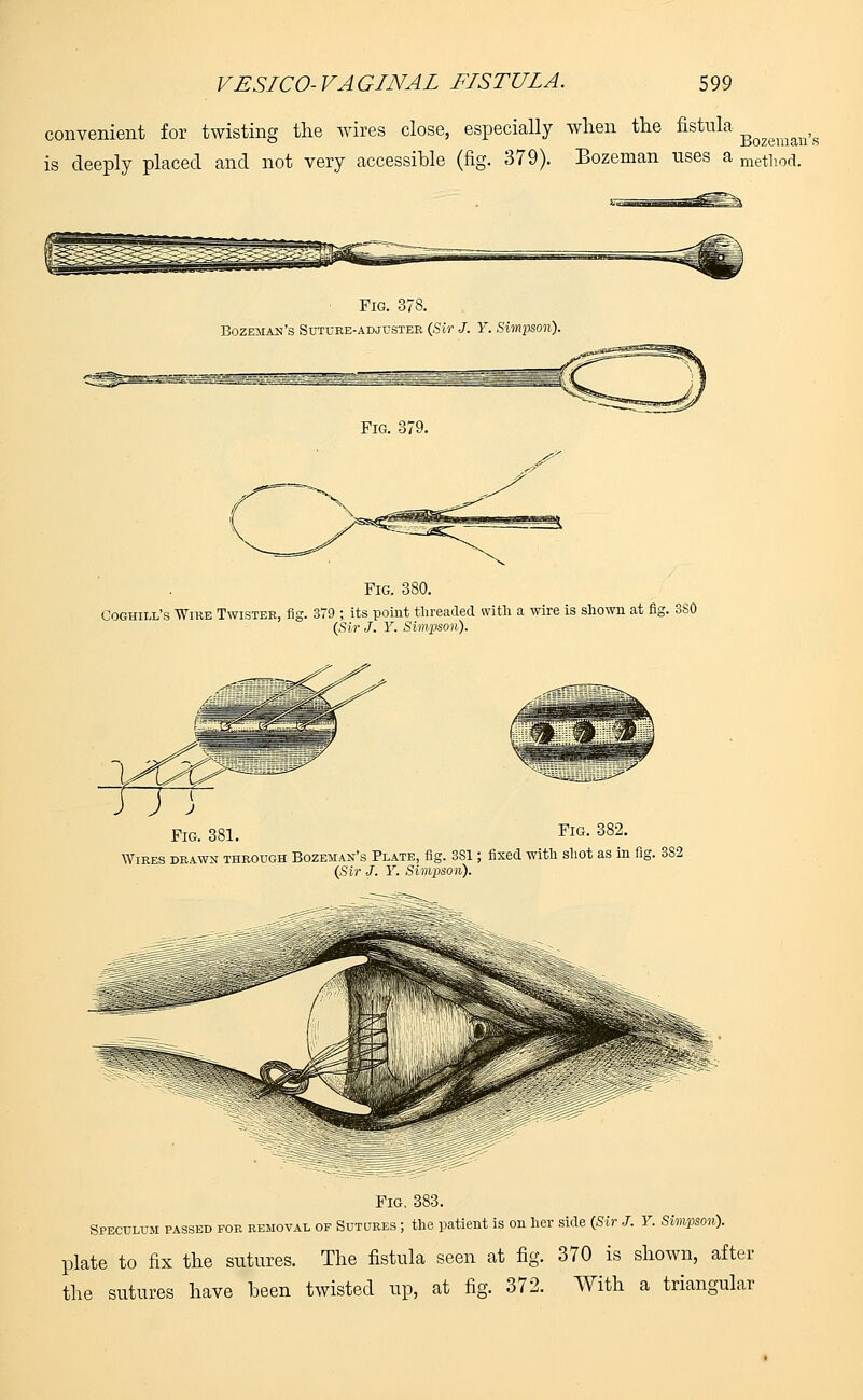 convenient for twisting the wires close, especially when the fistula Bozemall,s is deeply placed and not very accessible (fig. 379). Bozeman nses a method. Fig. 378. Bozeman's Suture-adjuster (Sir J. Y. Simpson). Fig. 380. Coghill's Wire Twister, fig. 379 ; its point threaded with a wire is shown at fig. 3S0 (Sir J. Y. Simpson). TTS Fig. 382. Fig. 381. Wires drawn through Bozeman's Plate, fig. 3S1; fixed with shot as in fig. 332 (Sir J. Y. Simpson). Fig. 383. Speculum passed for removal of Sutures ; the patient is on her side (Sir J. Y. Simpson). plate to fix the sutures. The fistula seen at fig. 370 is shown, after the sutures have been twisted up, at fig. 372. With a triangular