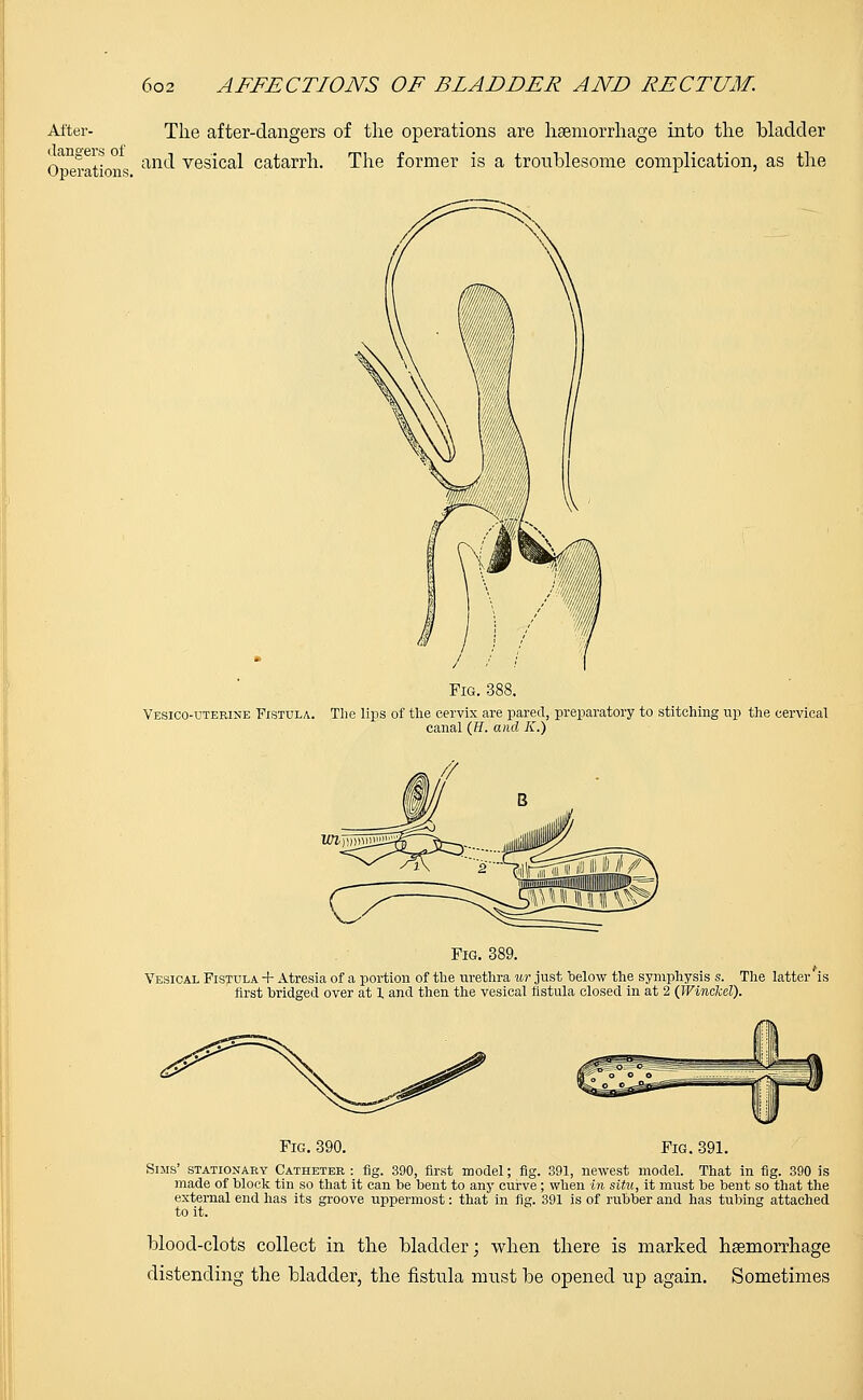 After- The after-clangers of the operations are haemorrhage into the bladder q. c, ,. and vesical catarrh. The former is a troublesome complication, as the Fig. 388. Vesicouterine Fistula. The lips of the cervix are pared, preparatory to stitching up the cervical canal (ff. and K.) Fig. 389. Vesical Fistula + Atresia of a portion of the urethra ur just below the symphysis s. The latter is first bridged over at 1 and then the vesical fistula closed in at 2 (Winckel). Fig. 390. Fig. 391. Sims' stationary Catheter : fig. 390, first model; fig. 391, newest model. That in fig. 390 is made of block tin so that it can be bent to any curve; when in situ, it must be bent so that the external end has its groove uppermost: that in fig. 391 is of rubber and has tubing attached to it. blood-clots collect in the bladder; when there is marked haemorrhage distending the bladder, the fistula must be opened up again. Sometimes