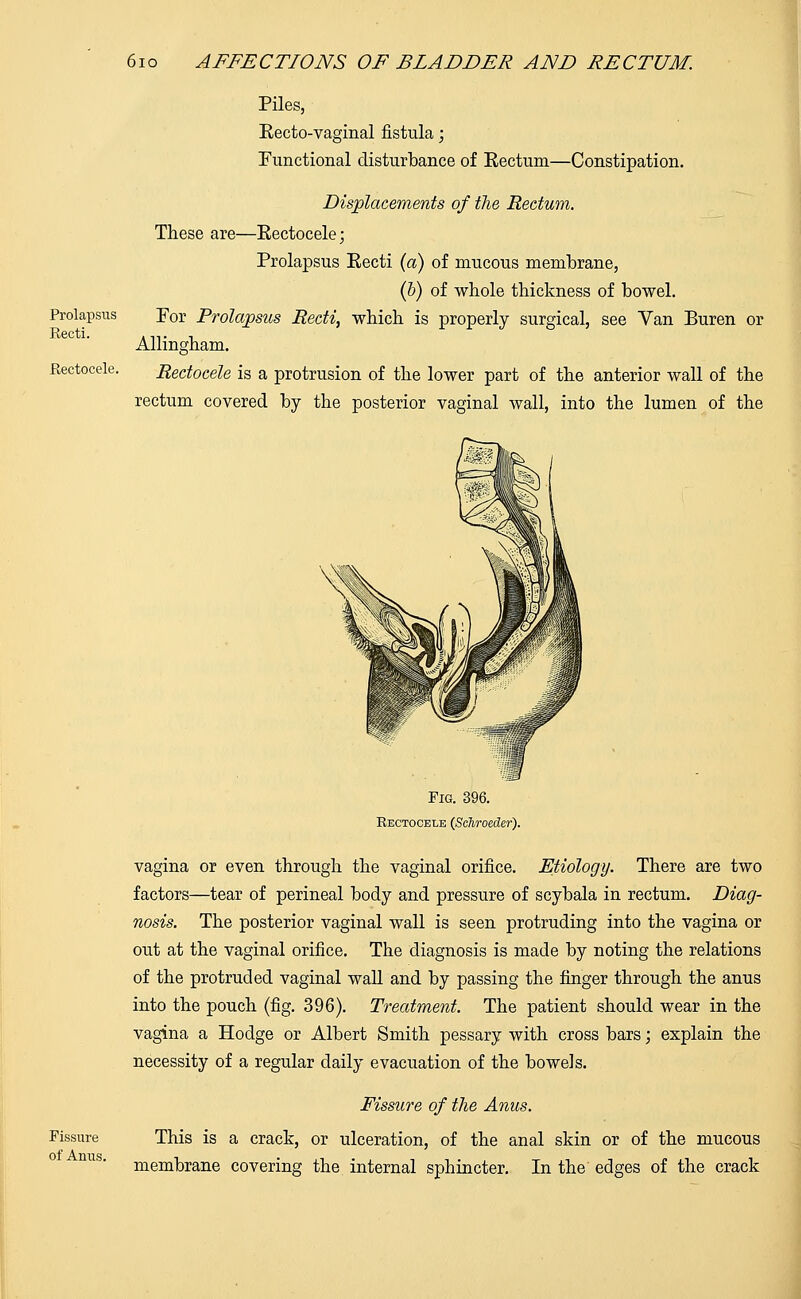 Prolapsus Eecti. Eectocele. 610 AFFECTIONS OF BLADDER AND RECTUM. Piles, Eecto-vaginal fistula; Functional disturbance of Eectum—Constipation. Displacements of the Rectum. These are—Eectocele; Prolapsus Eecti (a) of mucous membrane, (b) of whole thickness of bowel. Por Prolapsus Eecti, which is properly surgical, see Van Buren or Allingham. Rectocele is a protrusion of the lower part of the anterior wall of the rectum covered by the posterior vaginal wall, into the lumen of the Fissure of Anus. Fig. 396. Eectocelb (ScJiroeder). vagina or even through the vaginal orifice. Etiology. There are two factors—tear of perineal body and pressure of scybala in rectum. Diag- nosis. The posterior vaginal wall is seen protruding into the vagina or out at the vaginal orifice. The diagnosis is made by noting the relations of the protruded vaginal wall and by passing the finger through the anus into the pouch (fig. 396). Treatment. The patient should wear in the vagina a Hodge or Albert Smith pessary with cross bars; explain the necessity of a regular daily evacuation of the bowels. Fissure of the Anus. This is a crack, or ulceration, of the anal skin or of the mucous membrane covering the internal sphincter. In the edges of the crack