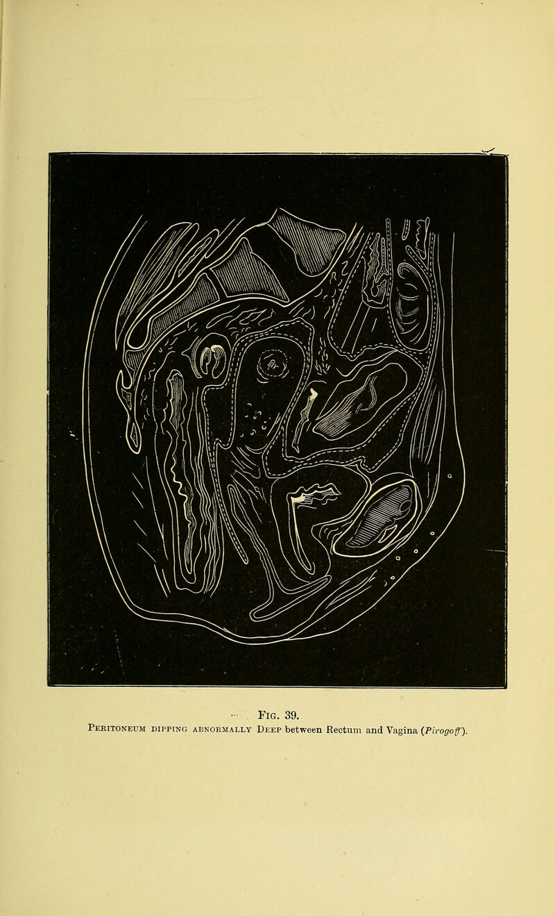 - . Fig. 39. Peritoneum dipping abnormally Deep between Rectum and Vagina (Pirogof).