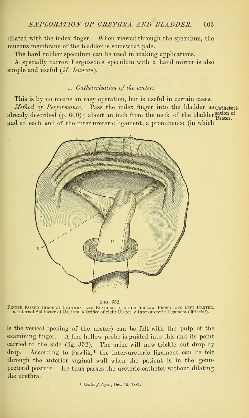 dilated with the index finger. When viewed through the speculum, the mucous membrane of the bladder is somewhat pale. The hard rubber speculum can be used in making applications. A specially narrow Fergusson's speculum with a hand mirror is also simple and useful (M. Duncan). c. Catheterisation of the ureter. This is by no means an easy operation, but is useful in certain cases. Method of Performance. Pass the index finger into the bladder as Catheteri- already described (p. 600); about an inch from the neck of the bladder !atl^nof and at each end of the inter-ureteric ligament, a prominence (in which Fig. 352. Finger passed through Urethra into Bladder to guide hollow Probe into left Ureter. a Internal Sphincter of Urethra, b Orifice of right Ureter, c Inter-ureteric Ligament (Winckel). is the vesical opening of the ureter) can be felt with the pulp of the examining finger. A fine hollow probe is guided into this and its point carried to the side (fig. 352). The urine will now trickle out drop by drop. According to Pawlik,1 the inter-ureteric ligament can be felt through the anterior vaginal wall when the patient is in the genu- pectoral posture. He thus passes the ureteric catheter without dilating the urethra. 1 Centr.f. Gyn., Oct. 15, 1881.