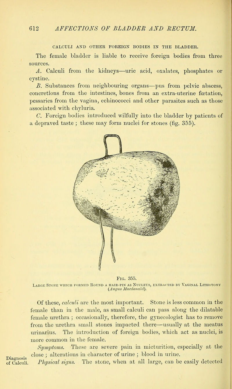 CALCULI AND OTHER FOREIGN BODIES IN THE BLADDER. The female bladder is liable to receive foreign bodies from three sources. A. Calculi from the kidneys—uric acid, oxalates, phosphates or cystine. B. Substances from neighbouring organs—pus from pelvic abscess, concretions from the intestines, bones from an extra-uterine fcetation, pessaries from the vagina, echinococci and other parasites such as those associated with chyluria. C. Foreign bodies introduced wilfully into the bladder by patients of a depraved taste ; these may form nuclei for stones (fig. 355). Fig. 355. Laege Stone which kormed Round a hair-pin as Nucleus, extracted by Vaginal Lithotomy (Angus Macdonald). Diagnosis of Calculi. Of these, calculi are the most important. Stone is less common in the female than in the male, as small calculi can pass along the dilatable female urethra ; occasionally, therefore, the gynecologist has to remove from the urethra small stones impacted there—usually at the meatus urinarius. The introduction of foreign bodies, which act as nuclei, is more common in the female. Symptoms. These are severe pain in micturition, especially at the close ; alterations in character of urine ; blood in urine. Physical signs. The stone, when at all large, can be easily detected