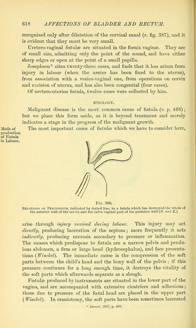 recognised only after dilatation of the cervical canal (v. fig. 387), and it is evident that they must be very small. Uretero-vaginal fistulse are situated in the fornix vaginae. They are of small size, admitting only the point of the sound, and have either sharp edges or open at the point of a small papilla. Josephson1 cites twenty-three cases, and finds that it has arisen from injury in labour (when the ureter has been fixed to the uterus), from association with a vesico-vagiual one, from operations on cervix and excision of uterus, and has also been congenital (four cases). Of uretero-uterine fistula, twelve cases were collected by him. ETIOLOGY. Malignant disease is the most common cause of fistula (v. p. 466); but we place this form aside, as it is beyond treatment and merely indicates a stage in the progress of the malignant growth. The most important cases of fistulee which we have to consider here, Relations of Peritoneum, indicated by dotted line, to a fistula which has destroyed the whole of the anterior wall of the cervix and the infra-vaginal part of the posterior wall (II. and K.) arise through injury received during labour. This injury may act directly, producing laceration of the septum; more frequently it acts indirectly, producing necrosis secondary to pressure or inflammation. The causes which predispose to fistula are a narrow pelvis and pendu- lous abdomen, a firm or large head (hydrocephalus), and face presenta- tions (Winckel). The immediate cause is the compression of the soft parts between the child's head and the bony wall of the pelvis ; if this pressure continues for a long enough time, it destroys the vitality of the soft parts which afterwards separate as a slough. Fistulse produced by instruments are situated in the lower part of the vagina, and are accompanied with extensive cicatrices and adhesions; those due to pressure of the foetal head are placed in the upper part (Winckel). In craniotomy, the soft parts have been sometimes lacerated '■'Lancet, 18S7, p. 496.