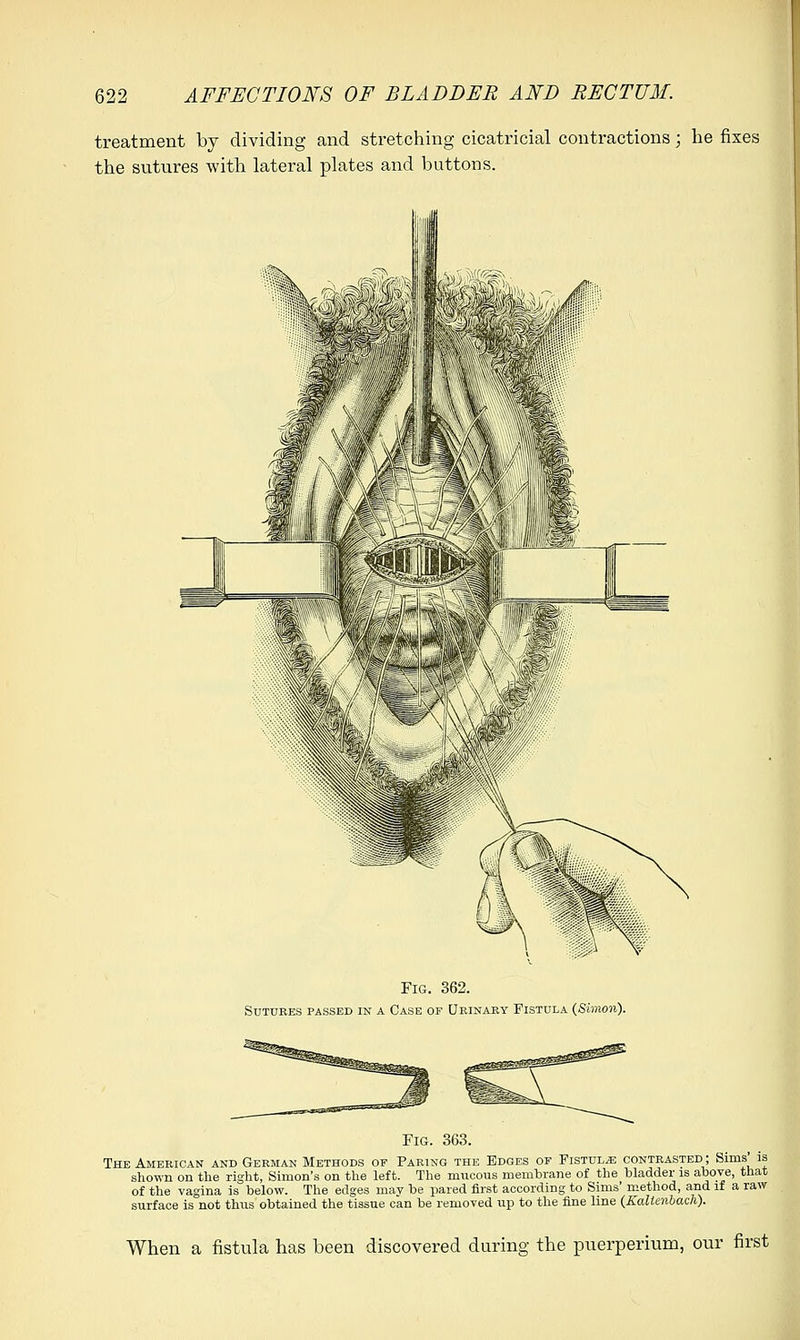 treatment by dividing and stretching cicatricial contractions; he fixes the sutures with lateral plates and buttons. Fig. 362. Sutures passed in a Case of Urinary Fistula (Simon). Fig. 363. The American and German Methods of Paring the Edges of Fistula contrasted ; Sims' is shown on the right, Simon's on the left. The mucous membrane of the bladder is above, that of the vagina is below. The edges may be pared first according to Sims' method, and if a raw surface is not thus obtained the tissue can be removed up to the fine line (Kallmbach). When a fistula has been discovered during the puerperium, our first