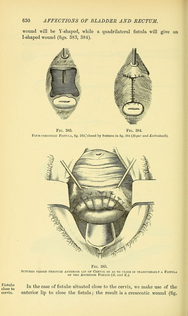 wound will be Y-shaped, while a quadrilateral fistula will give an I-shaped wound (figs. 383, 384). Fig. 383. Fig. 384. Four-cornered Fistula, fig. 3S3,'closed by Sutures in fig. 3S4 (Hegar and Kaltenbach). Fig. 385. Sutures passed through anterior lip of Cervix so as to close in transversely a Fistula of the Anterior Fornix (H. and K.). close to ^n ^e case °^ ^s^8e situated close to the cervix, we make use of the cervix. anterior lip to close the fistula; the result is a crescentic wound (fig.