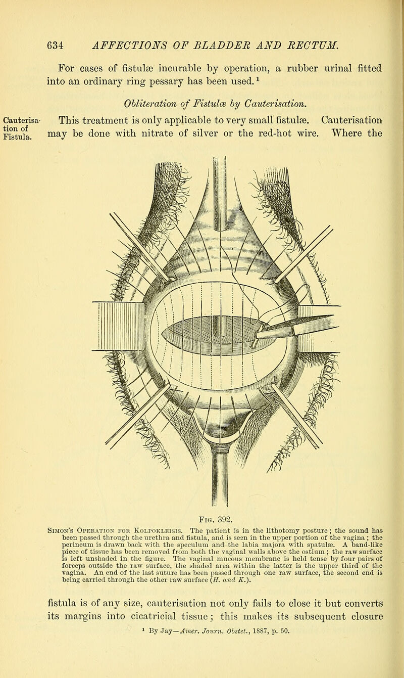 For cases of fistulae incurable by operation, a rubber urinal fitted into an ordinary ring pessary has been used.1 Obliteration of Fistula? by Cauterisation. Cauterisa- This treatment is only applicable to very small fistulee. Cauterisation Fi&tula. may be done with nitrate of silver or the red-hot wire. Where the Fig. 392. Simon's Operation for Kolpokleisis. The patient is in the lithotomy posture; the sound has been passed through the urethra and fistula, and is seen in the upper portion of the vagina ; the perineum is drawn back with the speculum and the labia majora with spatulas. A band-like piece of tissue has been removed from both the vaginal walls above the ostium ; the raw surface is left unshaded in the figure. The vaginal mucous membrane is held tense by four pairs of forceps outside the raw surface, the shaded area within the latter is the upper third of the vagina. An end of the last suture has been passed through one raw surface, the second end is being carried through the other raw surface (H. and K.). fistula is of any size, cauterisation not only fails to close it but converts its margins into cicatricial tissue; this makes its subsequent closure 1 By Jay— Amer. Joum. Obstet., 1S87, p. 50.
