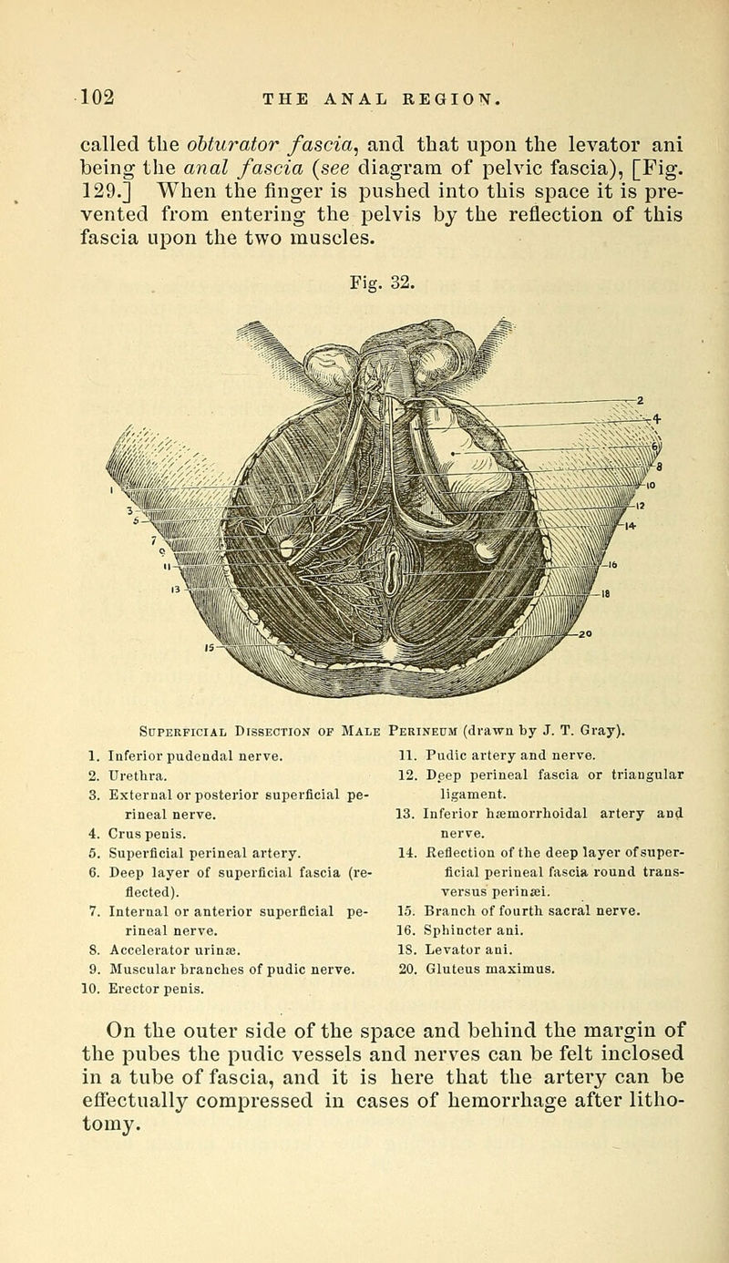 called the obturator fascia^ and that upon the levator ani being the anal fascia {see diagram of pelvic fascia), [Fig. 129.] When the finger is pushed into this space it is pre- vented from entering the pelvis by the reflection of this fascia upon the two muscles. Fig. 32. Superficial Dissection of Male 1. Inferior pudendal nerve. 2. Urettii'a. 3. External or posterior superficial pe- rineal nerve. 4. Crus penis. 5. Superficial perineal artery. 6. Deep layer of superficial fascia (re- flected). 7. Internal or anterior superficial pe- rineal nerve. 8. Accelerator urinse. 9. Muscular branches of pudic nerve. 10. Erector penis. Perineum (drawn by J. T. Gray). 11. Pudic artery and nerve. 12. Deep perineal fascia or triangular ligament. 13. Inferior hsemorrhoidal artery and nerve. 14. Keflection of the deep layer of super- ficial perineal fascia round trans- versus perinsei. 15. Branch of fourth sacral nerve. 16. Sphincter ani. IS. Levator ani. 20. Gluteus maximus. On the outer side of the space and behind the margin of the pubes the pudic vessels and nerves can be felt inclosed in a tube of fascia, and it is here that the artery can be efiectually compressed in cases of hemorrhage after litho- tomy.