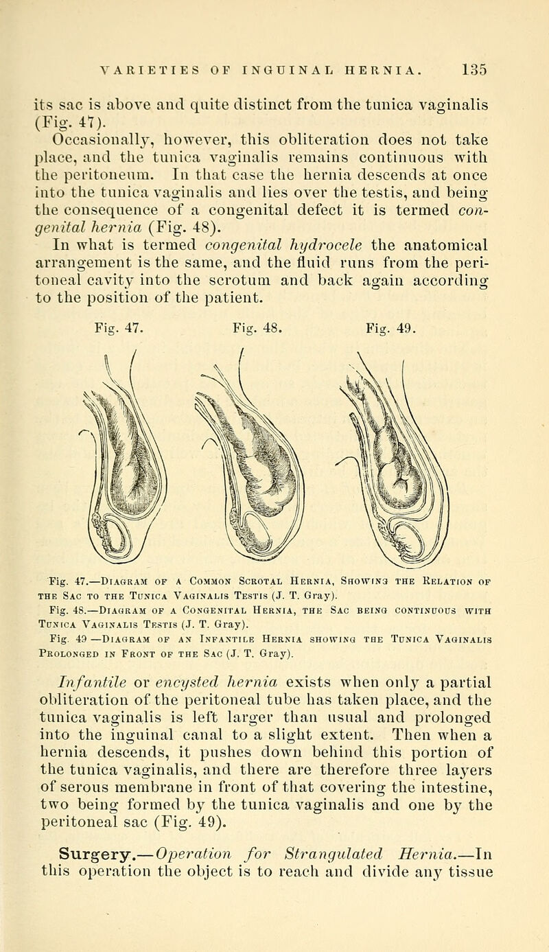 its sac is above and quite distinct from the tunica vaginalis (Fig. 4:1). Occasionally, however, this obliteration does not take place, and the tunica vaginalis remains continuous Avitli the peritoneum. In that case the hernia descends at once into the tunica vaginalis and lies over the testis, and being the consequence of a congenital defect it is termed con- genital hernia (Fig. 48). In what is termed congenital hydrocele the anatomical arrangement is the same, and the fluid runs from the peri- toneal cavity into the scrotum and back again according to the position of the patient. Fiff. 47. Fi^. 48. Fi?. 49. Fig. 47.—Diagram of a Common Scrotal Hernia, Showing the Relation op THE Sac to the Tunica Vaginalis Testis (J. T. Gray). Fig. 48.—Diahram op a Congenital Hernia, the Sac being continuous with Tunica Vaginalis Testis (J. T. Gray). Fig. 49 —Diagram of an Infantile Hernia showing the Tunica Vaginalis Prolonged in Front of the Sac (J. T. Gray). Infantile or encysted hernia exists when only a partial obliteration of the peritoneal tube has taken place, and the tunica vaginalis is left larger than usual and prolonged into the inguinal canal to a slight extent. Then when a hernia descends, it pushes down beliind this portion of the tunica vaginalis, and there are therefore three layers of serous membrane in front of that covering the intestine, two being formed by the tunica vaginalis and one by the peritoneal sac (Fig. 49). Surgery.— Operation for Strangulated Hernia.—In this operation the object is to reach and divide any tissue