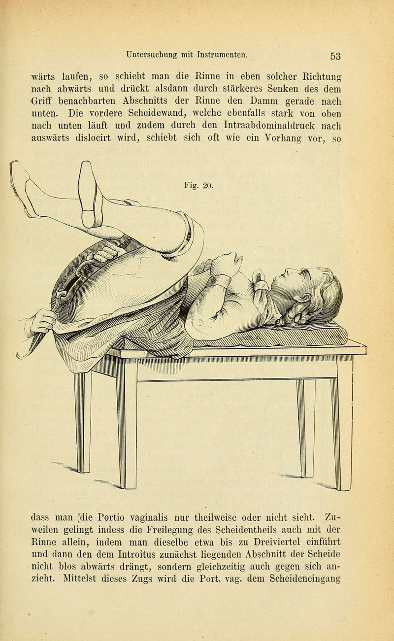 wärts laufen, so schiebt man die Rinne in eben solcher Richtung nach abwärts und drückt alsdann durch stärkeres Senken des dem Oriff benachbarten Abschnitts der Rinne den Damm gerade nach unten. Die vordere Scheidewand, welche ebenfalls stark von oben nach unten läuft und zudem durch den Intraabdominaldruck nach auswärts dislocirt wird, schiebt sich oft wie ein Vorhang vor, so Fiff. 20. dass man |die Portio vaginalis nur theilweise oder nicht sieht. Zu- weilen gelingt indess die Freilegung des Scheidentheils auch mit der Rinne allein, indem man dieselbe etwa bis zu Dreiviertel einführt und dann den dem Introitus zunächst liegenden Abschnitt der Scheide nicht blos abwärts drängt, sondern gleichzeitig auch gegen sich an- zieht. Mittelst dieses Zugs wird die Port. vag. dem Scheideneingang