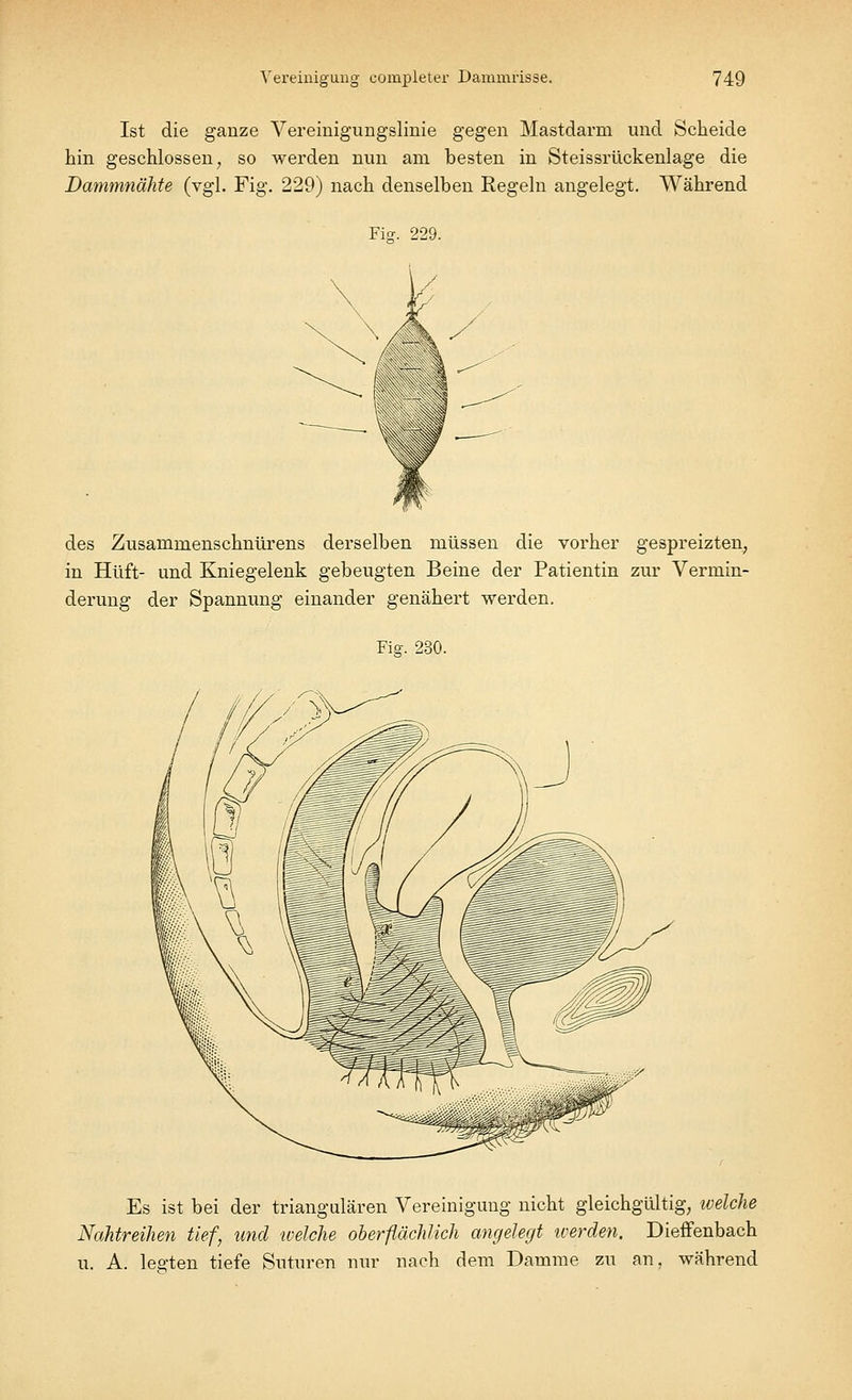 Ist die ganze Vereinigungslinie gegen Mastdarm und Scheide hin geschlossen, so werden nun am besten in Steissrückenlage die Dammnähte (vgl. Fig. 229) nach denselben Regeln angelegt. Während Fie. 229. des Zusammenschnürens derselben müssen die vorher gespreizten, in Hüft- und Kniegelenk gebeugten Beine der Patientin zur Vermin- derung der Spannung einander genähert werden. Fisr. 230. Es ist bei der triangulären Vereinigung nicht gleichgültig, tvelche Nahtreihen tief, und ivelche oberflächlich angelegt iverden. Dieffenbach u. A. legten tiefe Suturen nur nach dem Damme zu an, während