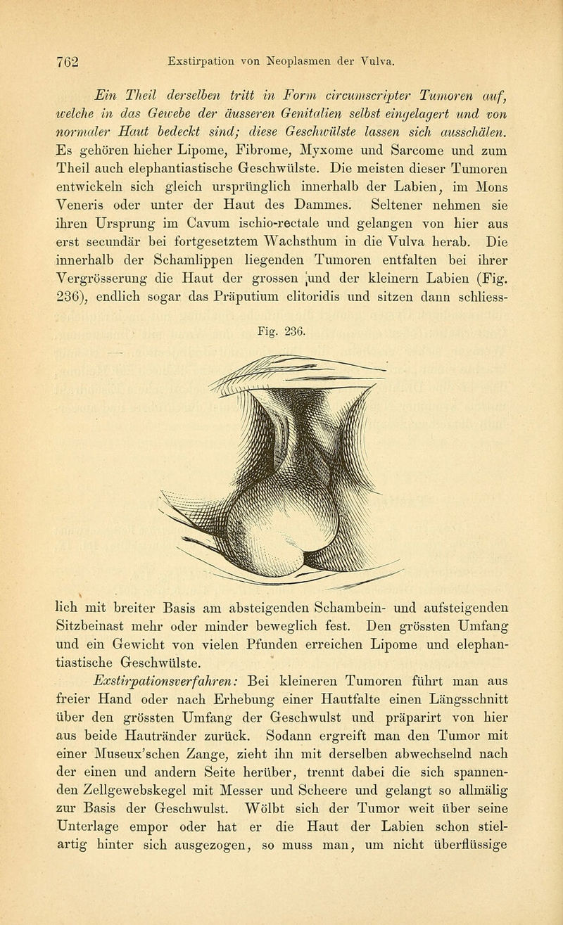 Ein Theil derselben tritt in Form circumscrijoter Tumoren auf, tvelche in das Gewebe der äusseren Genitalien selbst eingelagert und von normaler Haut bedeckt sind; diese Geschwülste lassen sich ausschalen. Es gehören hieher Lipome, Fibrome, Myxome und Sarcome und zum Theil auch elephantiastische Geschwülste. Die meisten dieser Tumoren entwickeln sich gleich ursprünglich innerhalb der Labien, im Mons Veneris oder unter der Haut des Dammes. Seltener nehmen sie ihren Ursprung im Cavum ischio-rectale und gelangen von hier aus erst secundär bei fortgesetztem Wachsthum in die Vulva herab. Die innerhalb der Schamlippen liegenden Tumoren entfalten bei ihrer Vergrößerung die Haut der grossen jund der kleinern Labien (Fig. 236), endlich sogar das Präputium clitoridis und sitzen dann schliess- Fig. 236. lieh mit breiter Basis am absteigenden Schambein- und aufsteigenden Sitzbeinast mehr oder minder beweglich fest. Den grössten Umfang und ein Gewicht von vielen Pfunden erreichen Lipome und elephan- tiastische Geschwülste. Exstirpationsver fahren: Bei kleineren Tumoren führt man aus freier Hand oder nach Erhebung einer Hautfalte einen Längsschnitt über den grössten Umfang der Geschwulst und präparirt von hier aus beide Hautränder zurück. Sodann ergreift man den Tumor mit einer Museux'schen Zange, zieht ihn mit derselben abwechselnd nach der einen und andern Seite herüber, trennt dabei die sich spannen- den Zellgewebskegel mit Messer und Scheere und gelangt so allmälig zur Basis der Geschwulst. Wölbt sich der Tumor weit über seine Unterlage empor oder hat er die Haut der Labien schon stiel- artig hinter sich ausgezogen, so muss man, um nicht überflüssige