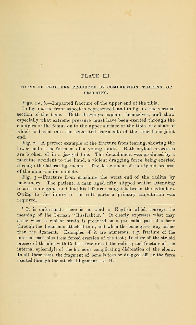 FORMS OF PBACTUEE PRODTJCED BY COMPRESSION, TEARING, OB CRUSHING. Figs. I fl, b.—Impacted fracture of the upper end of the tibia. In fig. I a the front aspect is represented, and in fig. i b the vertical section of the bone. Both drawings explain themselves, and show especially what extreme pressure must have been exerted through the condyles of the femur on to the upper surface of the tibia, the shaft of which is driven into the separated fragments of the cancellous joint end. Fig. 2.—A perfect example of the fracture from tearing, showing the lower end of the forearm of a young adult.^ Both styloid processes are bi-oken off in a jagged line. The detachment was produced by a machine accident to the hand, a violent dragging force being exerted through the lateral ligaments. The detachment of the styloid process of the ulna was incomplete. ^i§'- 3-—Fracture from crushing the wrist end of the radius by machinery. The patient, a man aged fifty, slipped whilst attending to a steam engine, and had his left arm caught between the cylinders. Owing to the injury to the soft parts a primary amputation was required. ^ It is unfortunate there is no word in English which conveys the meaning of the German  Rissfraktur. It clearly expresses what may occur when a violent strain is produced on a particular part of a hone through the ligaments attached to it, and when the bone gives way rather than the ligament. Examples of it are numerous, e.g. fracture of the internal malleolus from forced aversion of the foot; fracture of the styloid process of the ulna with Colles's fracture of the radius ; and fracture of the internal epicondyle of the humerus complicating dislocation of the elbow. In all these cases the fragment of bone is torn or dragged off by the force exerted through the attached lisrament.—J. H.