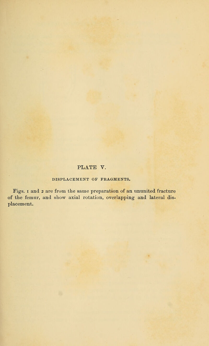 DISPLACEMENT OF FRAGMENTS. Figs. I and 2 ave from the same preparation of an ununited fracture of tLe femur, and show axial rotation, overlapping and lateral dis- placement.
