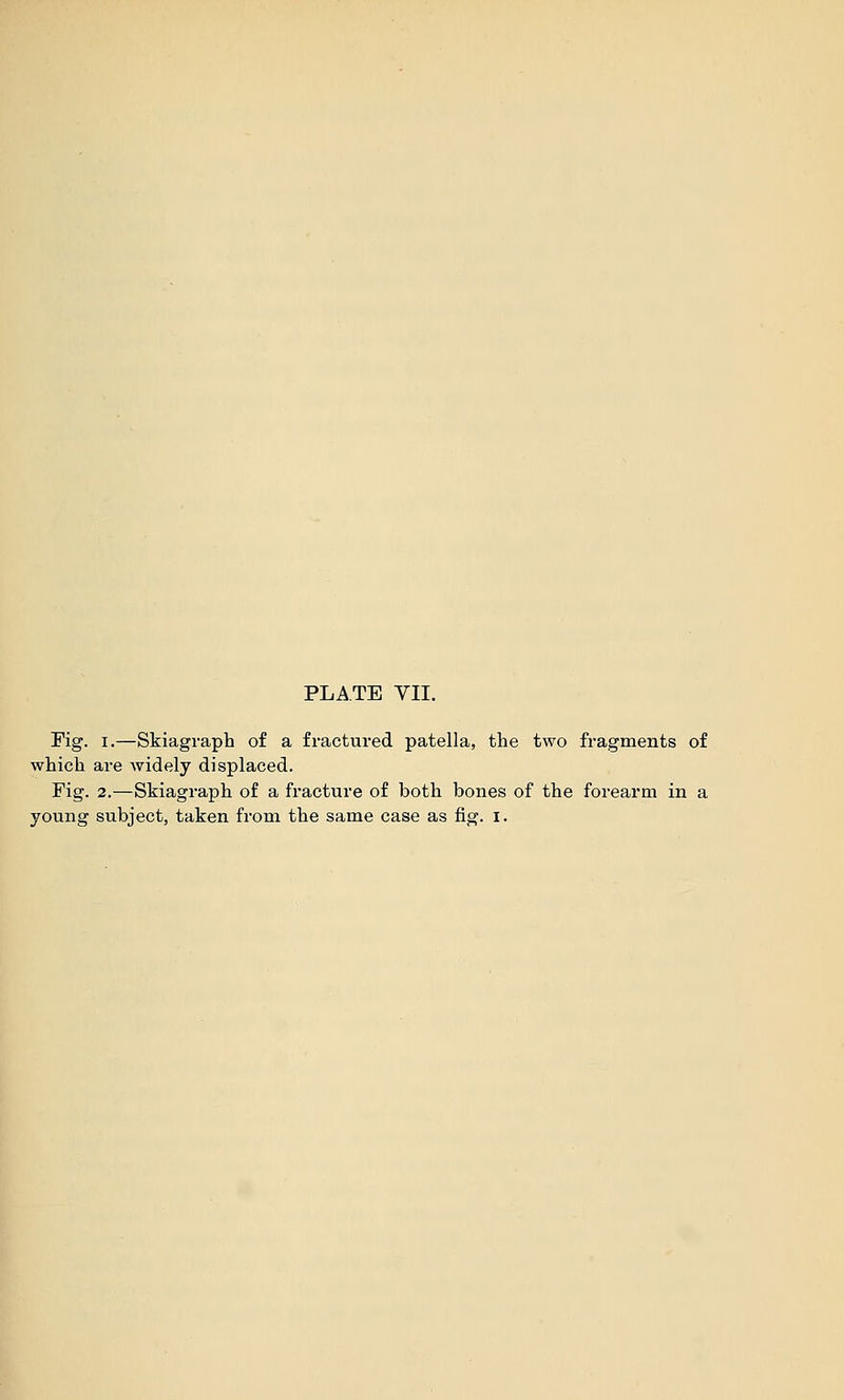 Fig. I.—Skiagraph of a fractured patella, the two fragments of which are widely displaced. Fig. 2.—Skiagraph of a fracture of both bones of the forearm in a young subject, taken from the same case as fig. i.