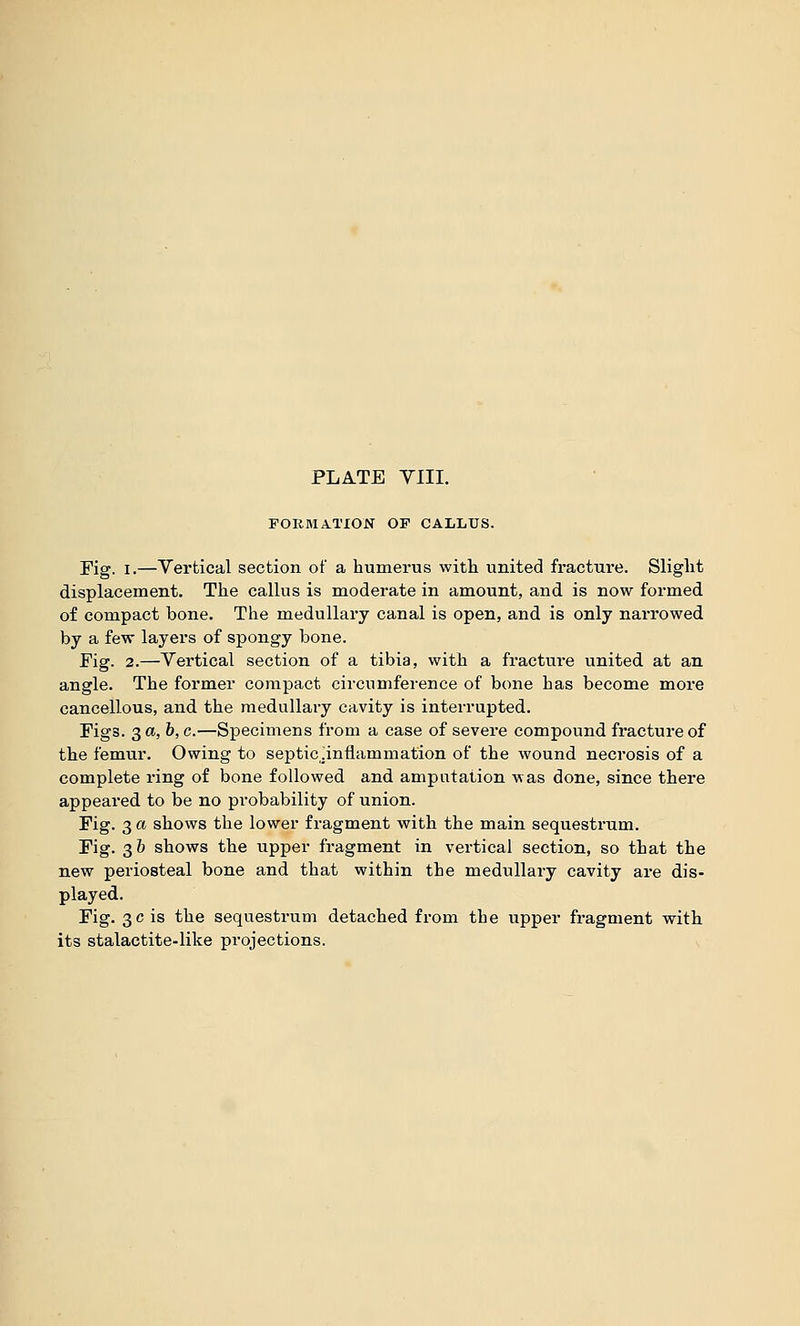 FORMATION OF CALLUS. Fig. I.—Yerfcical section of a humerus with united fracture. Slight displacement. The callus is moderate in amount, and is now formed of compact bone. The medullary canal is open, and is only narrowed by a few layers of spongy bone. Fig. 2.—Vertical section of a tibia, with a fracture united at an angle. The former compact circumference of bone has become more cancellous, and the medullary cavity is interrupted. Figs. 3«, b,c.—Specimens from a case of severe compound fracture of the femur. Owing to septic.inflammation of the wound necrosis of a complete ring of bone followed and amputation was done, since there appeared to be no probability of union. Fig. 3 a shows the lower fragment with the main sequestrum. Fig. 3& shows the upper fragment in vertical section, so that the new periosteal bone and that within the medullary cavity are dis- played. Fig. 3eis the sequestrum detached from the upper fragment with its stalactite-like projections.