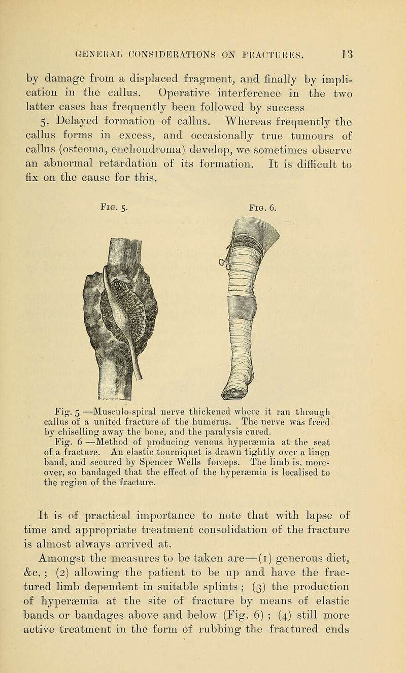 by damage from a displaced fragment^ and finally by impli- cation in the callus. Operative interference in the two latter cases has frequently been followed by success 5. Delayed formation of callus. Whereas frequently the callus forms in excess^ and occasionally true tumours of callus (osteoma^ enchondfoma) develop^ we sometimes observe an abnormal retardation of its formation. It is difficult to fix on the cause for this. Fig. 5. Fig. 6. fig. 5—Musculo-spiral nerve thickened where it ran through callus of a united fracture of the humerus. The nerve was freed by cliiselling away the bone, and the paralysis cured. Fig. 6 —Method of producing venous hypersemia at the seat of a fracture. An elastic tourniquet is drawn tightly over a linen band, and secured by Spencer Wells forceps. The limb is, more- over, so bandaged that the efEect of the hypersemia is localised to the region of the fracture. It is of practical importance to note that with lapse of time and appropriate treatment consolidation of the fracture is almost always arrived at. Amongst the measures to be taken are—(i) generous diet^ &c.; (2) allowing the patient to be up and have the frac- tured limb dependent in suitable splints; (3) the production of hyperasmia at the site of fracture by means of elastic bands or bandages above and below (Fig. 6) ; (4) still more active treatment in the form of rubbing the fractured ends