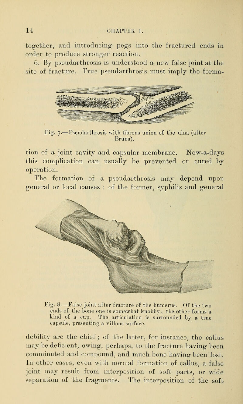 together, and introducing pegs into the fractured ends in order to produce stronger reaction. 6. By pseudarthrosis is understood a new false joint at the site of fracture. True pseudarthrosis must imply the forma- Fig. 7.—Pseudarthrosis with fibrous union of the ulna (after Bruns). tion of a joint cavity and capsular membrane. Now-a-days this complication can usually be prevented or cured by operation. The formation of a pseudarthrosis may depend upon general or local causes : of the former, syphilis and general ''>^. <^.. Fig. 8.—False joint after fracture of the humerus. Of the two ends of the bone one is somewhat knobby; the other forms a kind of a cup. The articulation is surrounded by a true capsule, presenting a villous surface. debility are the chief; of the latter, for instance, the callus may be deficient, owing, perhaps, to the fracture having been comminuted and compound, and much bone having been lost. In other cases, even with normal formation of callus, a false joint may result from interposition of soft parts, or wide separation of the fragments. The interposition of the soft