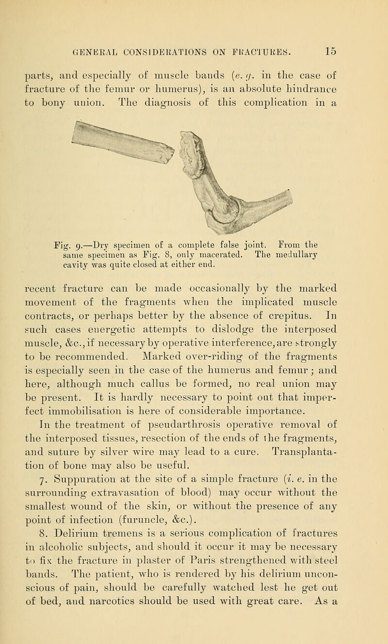 pai'tSj and especially of muscle bauds (e. (j. in the case of fracture of tlie femur or humerus)^ is an absolute hindrance to bony union. The diagnosis of this complication in a r*s \ Fig. 9.—Dry specimen oE a complete fiilse joint. From the same specimen as Fig. 8, only macerated. Tiie medullary cavity was quite closed at either end. recent fracture can be made occasionally by the marked movement of the fragments when the implicated muscle contracts^ or perhaps better by the absence of crepitus. In such cases energetic attempts to dislodge the interposed muscle, &c.,if necessary by operative interference, are strongly to be recommended. Marked over-riding of the fragments is especially seen in the case of the humerus and femur; and here, although much callus be formed, no real union may be present. It is hardly necessary to point oat that imper- fect immobilisation is here of considerable importance. In the treatment of pseudarthrosis operative removal of the interposed tissues, resection of the ends of the fragments, and suture by silver wire may lead to a cure. Transplanta- tion of bone may also be iTseful. 7. Suppuration at the site of a simple fracture [i. e. in the surrounding extravasation of blood) may occur without the smallest wound of the skin, or without the presence of any point of infection (furuncle, &c.). 8. Delirium tremens is a serious complication of fractures in alcoholic subjects, and should it occur it may be necessary to fix the fracture in plaster of Paris strengthened with steel bands. The patient, who is rendered by his delirium uncon- scious of pain, should be carefully watched lest he get out of bed, aud narcotics should be used with great care. As a