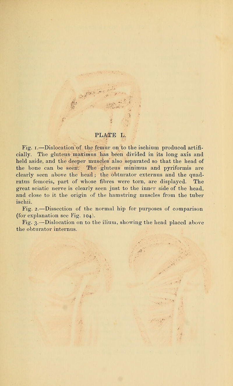 PLATE L Fig. I.—Dislocation of the femui on to the ischium produced artifi- cially. The gluteus ma\iinns has been divided in its long axis and held aside, and the deepei muscles also sepaiated so that the head of the bone can be seen The gluteus minimus and pyriformis are clearly seen above the head , the obtui atoi esternns and the quad- ratus femoris, part of vrhose fibres were torn, are displayed. The great sciatic nerve is clearly seen just to the inner side of the head, and close to it the origin of the hamstring muscles from the ttiber ischii. Fig. 2.—Dissection of the normal hip for purposes of comparison (for explanation see Fig. 104). Fig. 3.—Dislocation on to the ilium, showing the head placed above the obturator internus. j3-