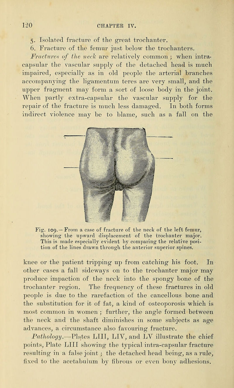 5. Isolated fracture of the great trochanter. 6. Fracture of the femur just below the trochanters. Fractures of the vech are relatively common ; when intra- capsular the vascular supply of the detached head is much impaired^ especially as in old people the arterial branches accompanying the ligamentuni teres are very small^ and the upper fragment may form a sort of loose body in the joint. When partly extra-capsular the vascular supply for the repair of the fracture is much less damaged. In both forms indirect violence may be to blame, such as a fall on the r ^-ir— ^ 1 I ' ^L^^ / ^w^^ ■^ r r Fig. 109. —From a ca,se of fracture of the neck of the left femur, showing the upward displacement of the trochanter major. This is made especially evident by comparing the relative posi- tion of the lines drawn through the anterior superior spines. knee or the patient tripping up from catching his foot. In other cases a fall sideways on to the trochanter major may produce impaction of the neck into the spongy bone of the trochanter region. The frequency of these fractures in old people is due to the rarefaction of the cancellous bone and the substitution for it of fat, a kind of osteoporosis which is most common in women ; further, the angle formed between the neck and the shaft diminishes in some subjects as age advances, a circumstance also favouring fracture. Pathology.—^Plntes LIII, LIV, and LV illustrate the chief points, Plate LIII showing the typical intra-capsular fracture resulting in a false joint; the detached head being, as n rule, fixed to the acetabulum by fibrous or even bony adhesions.