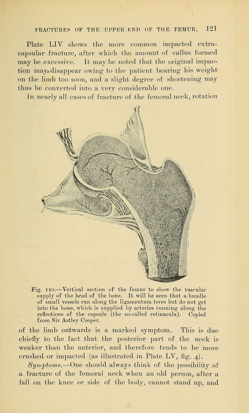 Plate LIV sliows the more common impacted extra- capsular fracture^ after which the amount of callus formed may be excessive. It maybe noted that the original impac- tion may» disappear owing to the patient bearing his weight on the limb too soon^, and a slight degree of shortening may thus be converted into a very considerable one. Jn nearly all cases of fracture of the femoral neck^ rotation  ^''/ '^ ; :.^ Fig. no.—Vertical section of the femur to sliow the vascular supply of the head of the hone. It will be seen that a bundle of small vessels run along the ligamentum teres but do not get into the bone, which is supplied by arteries running along the reflections of the capsule (the so-called retinacula). Copied from Sir Astley Cooper. of the limb outwards is a marked symptom. This is due chiefly to the fact that the posterior part of the neck is weaker than the anterior, and therefore tends to be more crushed or impacted (as illustrated in Plate LV, fig. 4). Syvcptoms.—One should always think of the possibility of a fracture of the femoral neck when an old person, after a fall on the knee or side of the body, cannot stand up, and
