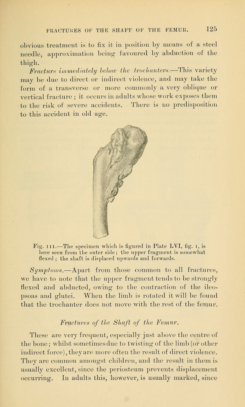obvious treatment is to fix it in position by means of a steel needle^ approximation being favoured by abduction of the thigli. Fracture immediately helow the troctianters.—This variety may be due to direct or indirect violence^ and may take the form of a transverse or more commonly a very oblique or vertical fracture ; it occurs in adults whose work exposes them to the risk of severe accidents. There is no predisposition to this accident in old age. /J Pig. III.—The specimen wliich is figured in Plate LVI, fig. i, is here seen from the outer side; tlie upper fragment is somewhat flexed ; the shaft is displaced upwards and forwards. Sympto'iiis.—Apart from those common to all fractures^ we have to note that the upper fragment tends to be strongly flexed and abducted^ owing to the contraction of the ileo- psoas and glutei. When the limb is rotated it will be found that the trochanter does not move with the rest of the femur. Fractures of the Shaft of the Femur. These are very frequent, especially just above the centre of the bone; whilst sometimes due to twisting of the limb (or other indirect force), they are more often the result of direct violence. They are common amongst children, and the result in them is usually excellent, since the periosteum prevents displacement occurring. In adults this, however, is usually marked, since