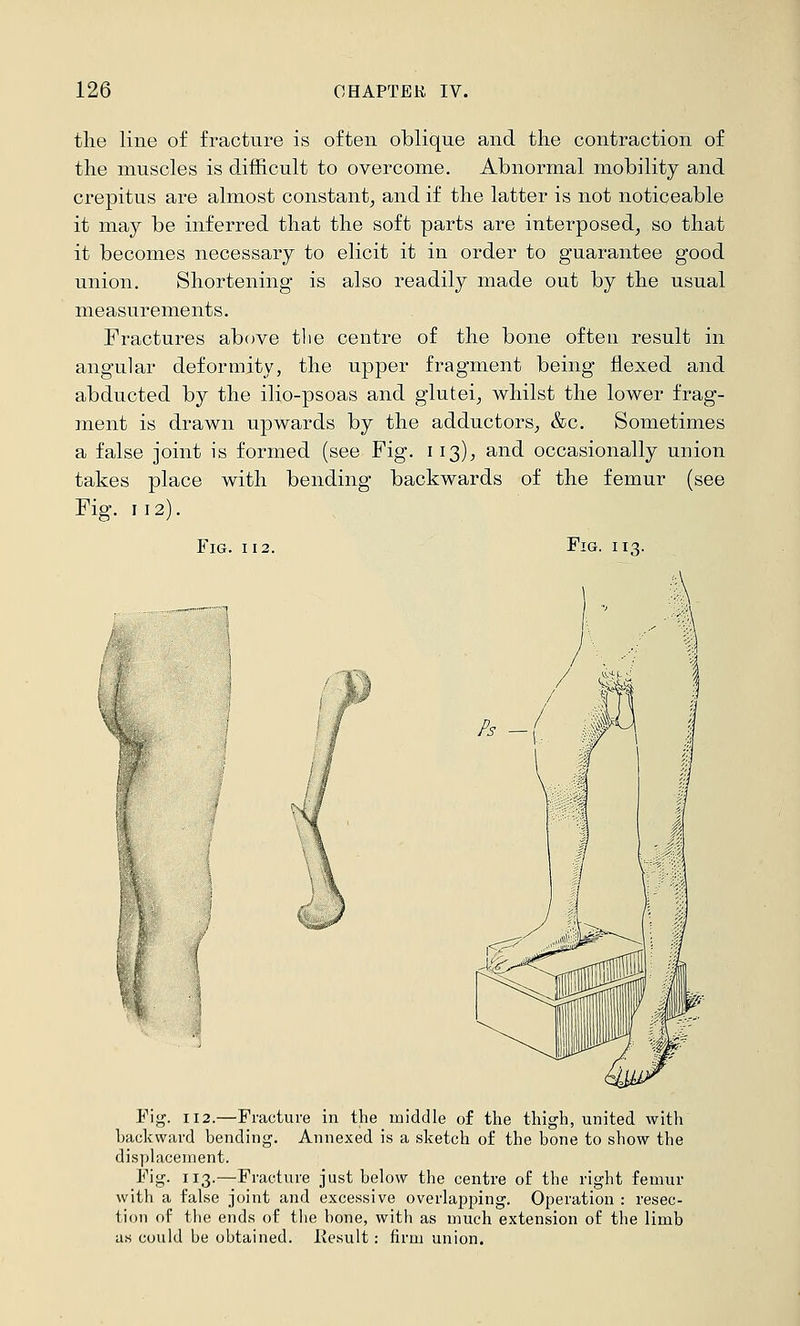 the line of fracture is often oblique and the contraction of the muscles is difficult to overcome. Abnormal mobility and crepitus are almost constant^ and if the latter is not noticeable it may be inferred that the soft parts are interposed^ so that it becomes necessary to elicit it in order to guarantee good union. Shortening is also readily made out by the usual measurements. Fractures above tlie centre of the bone often result in angular deformity, the upper fragment being flexed and abducted by the ilio-psoas and glutei, whilst the lower frag- ment is drawn upwards by the adductors^ &c. Sometimes a false joint is formed (see Fig. 113), and occasionally union takes place with bending backwards of the femur (see Fig-. 112). Fig. 112. Fiu. 113. Fig. 112.—Fracture in the middle of the thigh, united with backward bending. Annexed is a sketch of the bone to show the displacement. Fig. 113.—Fracture just below the centre of the right femur with a false joint and excessive overlapping. Operation : resec- tion of the ends of the bone, with as much extension of the limb us could be obtained. Ilesult: firm union.