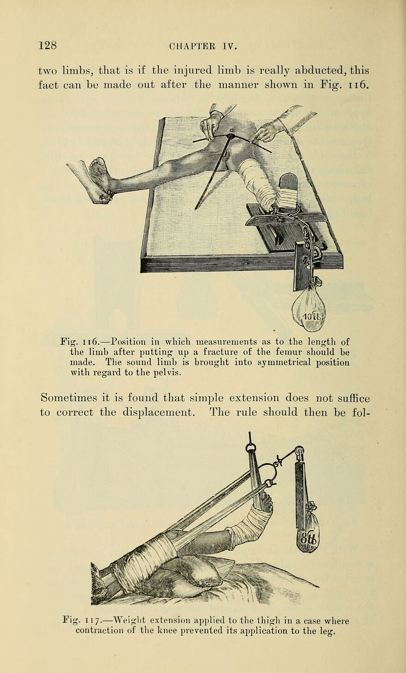 two limbs^ that is if the injured limb is really abducted, this fact can be made out after the manner shown in Fig. ii6. . X Fig. 116.—Position in whicli measurements as to the length of the limb after putting up a fracture of the femur should be made. The sound limb is brought into symmetrical position with regard to the pelvis. Sometimes it is found that simple extension does not suffice to correct the displacement. The rule should then be fol- Fig. 117.—Weight extension applied to the thigli in a case where contraction of the knee prevented its application to the leg.
