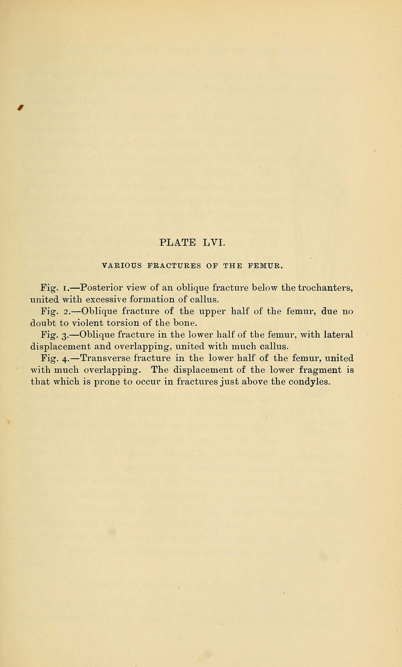 PLATE LVI. VARIOUS FEA.CTUE.es OF THE FEMUE. Fig. I.—Posterior view of an oblique fracture below the trochanters, united with excessive formation of callus. Pig. 2.—Oblique fracture of the upper half of the femur, due no doubt to violent torsion of the bone. Pig. 3.—Oblique fracture in the lower half of the femur, with lateral displacement and overlapping, united with much callus. Pig. 4.—Transverse fracture in the lower half of the femur, united with much overlapping. The displacement of the lower fragment is that which is prone to occur in fractures just above the condyles.