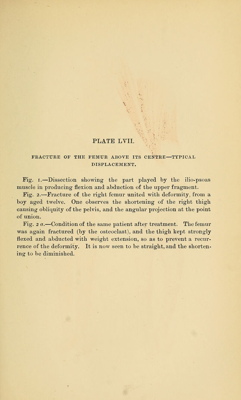 PLATE Lvii. : ,; FEACTUEE OF THE FEMUE ABOVE ITS CENTEE—TYPICAL DISPLACEMENT. Fig. I.—Dissection showing the part played by the ilio-psoas muscle in producing flexion and abduction of the upper fragment. Fig. 2.—Fracture of the right femur united with deformityj from a boy aged twelve. One observes the shortening of the right thigh causing obliquity of the pelvis, and the angular projection at the point of union. Fig. 2 «.—Condition of the same patient after treatment. The femur was again fractured (by the osteoclast), and the thigh kept strongly flexed and abducted with weight extension, so as to prevent a recur- i'ence of the deformity. It is now seen to be straight, and the shorten- ing to be diminished.