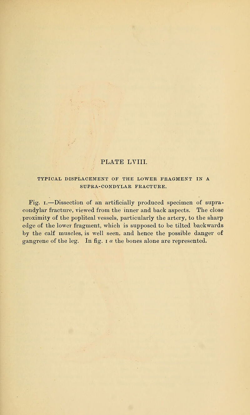 PLATE LVIII. TYPICAL DISPIiACEMENT OF THE LOWER FRAGMENT IN A SUPRA-CONDYLAR FRACTURE. Fig. I.—Dissection of an ai'tificially produced specimen of supra- condylar fracture, viewed from the inner and back aspects. The close proximity of the popliteal vessels, particularly the artery, to the sharp edge of the lower fragment, which is supposed to be tilted backwai'ds by the calf muscles, is well seen, and hence the possible danger of