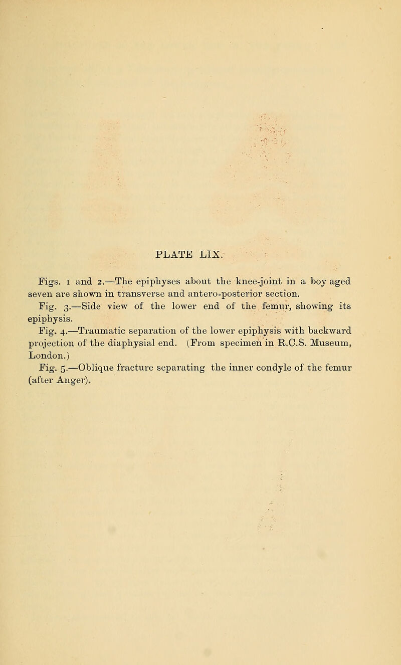 Figs. I and 2.—The epiphyses about the knee-joint in a boy aged seven are shown in transverse and antero-posterior section. Fig. 3.—Side view of the lower end of the femur, showing its epiphysis. Fig. 4.—Traumatic separation of the lower epiphysis with backward projection of the diaphysial end. (From specimen in R.C.S. Museum, London.) Fig. 5.—Oblique fracture separating the inner condyle of the femur (after Anger).