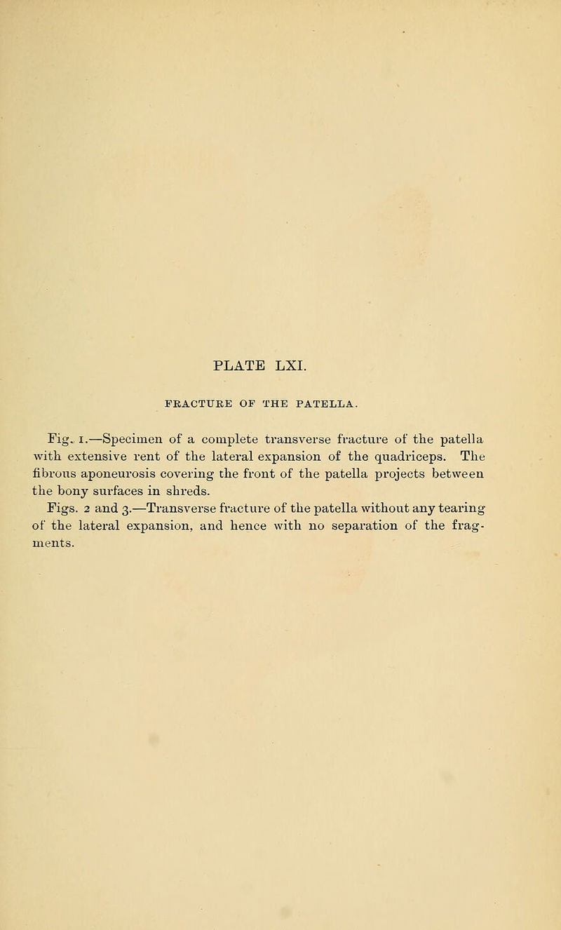 FRACTUEE OF THE PATELLA. Fig» I.—Specimen of a complete transverse fractvire of the patella with, extensive rent of the lateral expansion of the quadriceps. The fibrous aponeurosis covering the front of the patella projects between the bony surfaces in shreds. Figs. 2 and 3.—Transverse fractui-e of the patella without any tearing of the lateral expansion, and hence with no separation of the frag- ments.